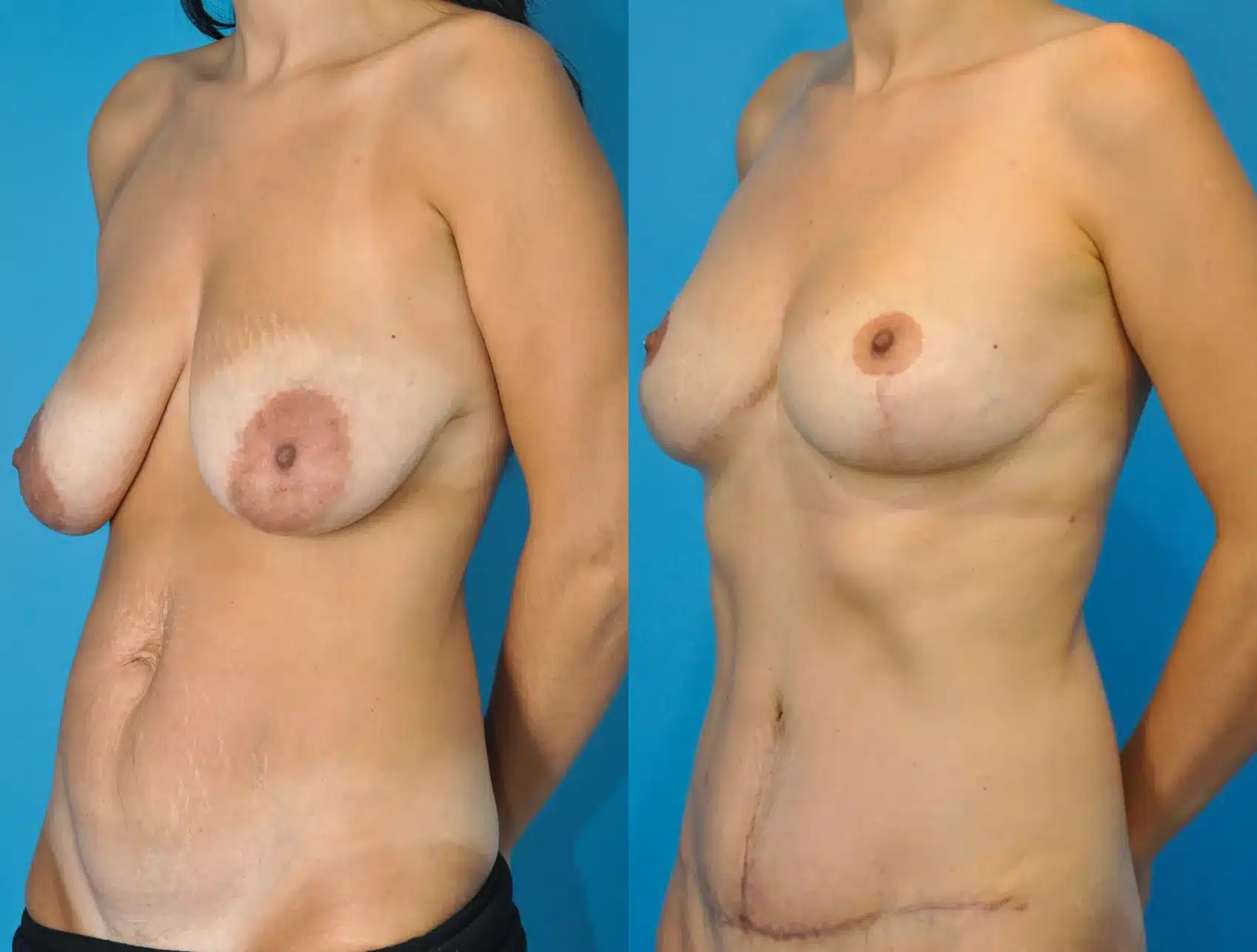 Before and After Image: Breast Lift and Tummy Tuck - left-front-oblique