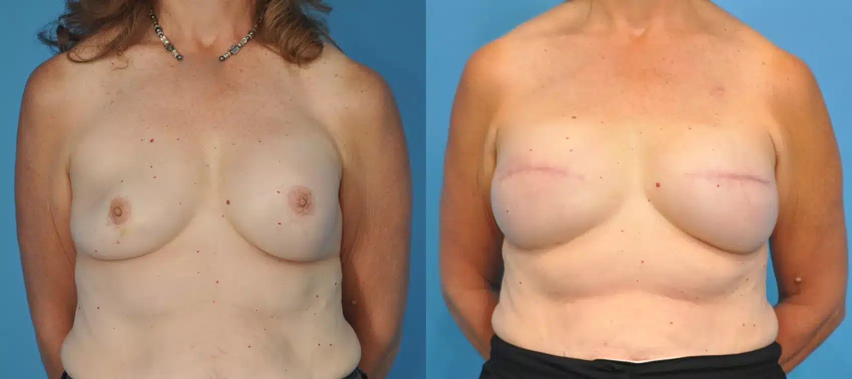 Before and After Image: Case #72 - front