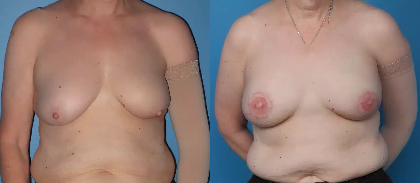 Before and After Image: Case #73 - front