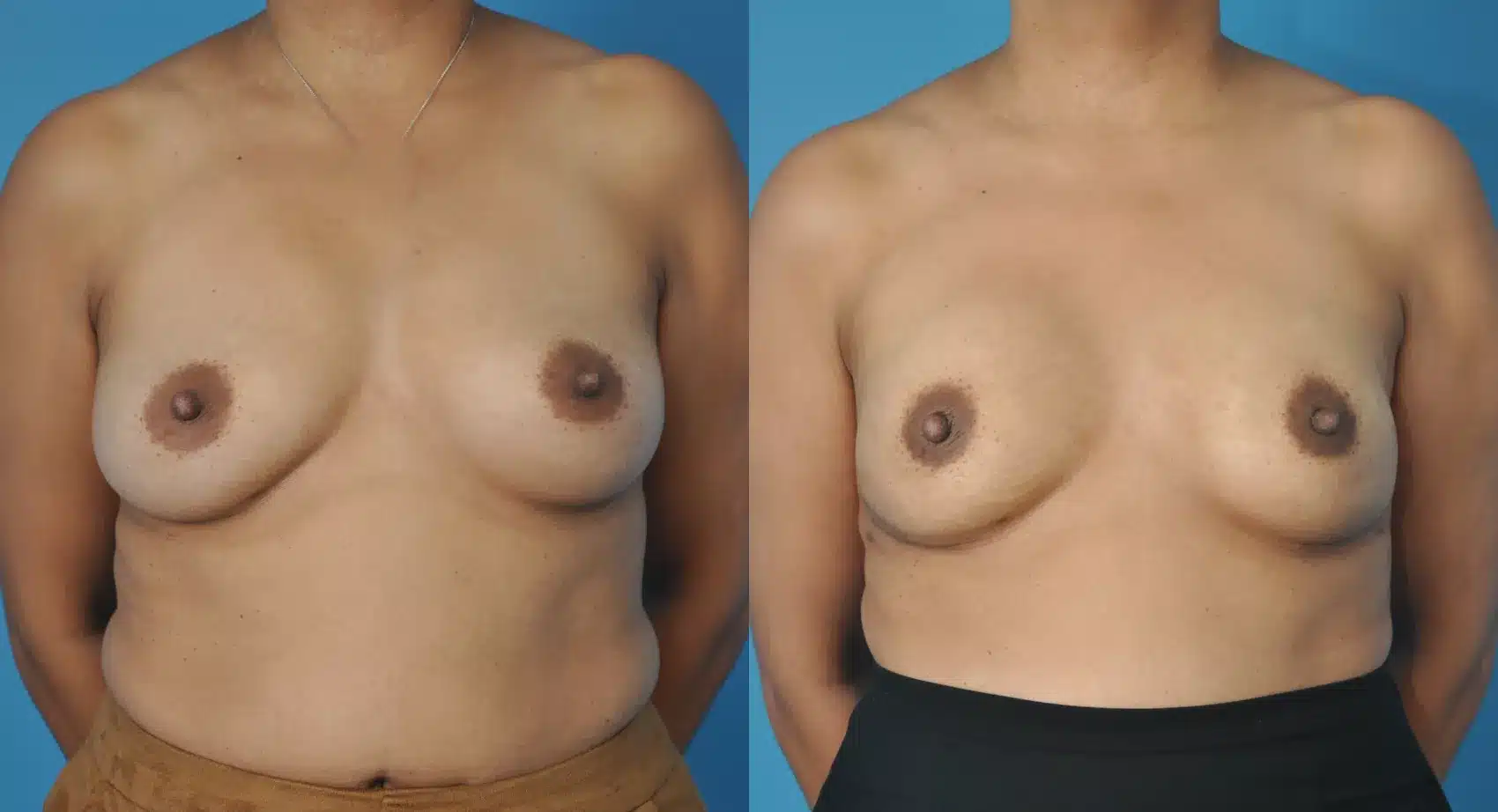 Before and After Image: Case #74 - front