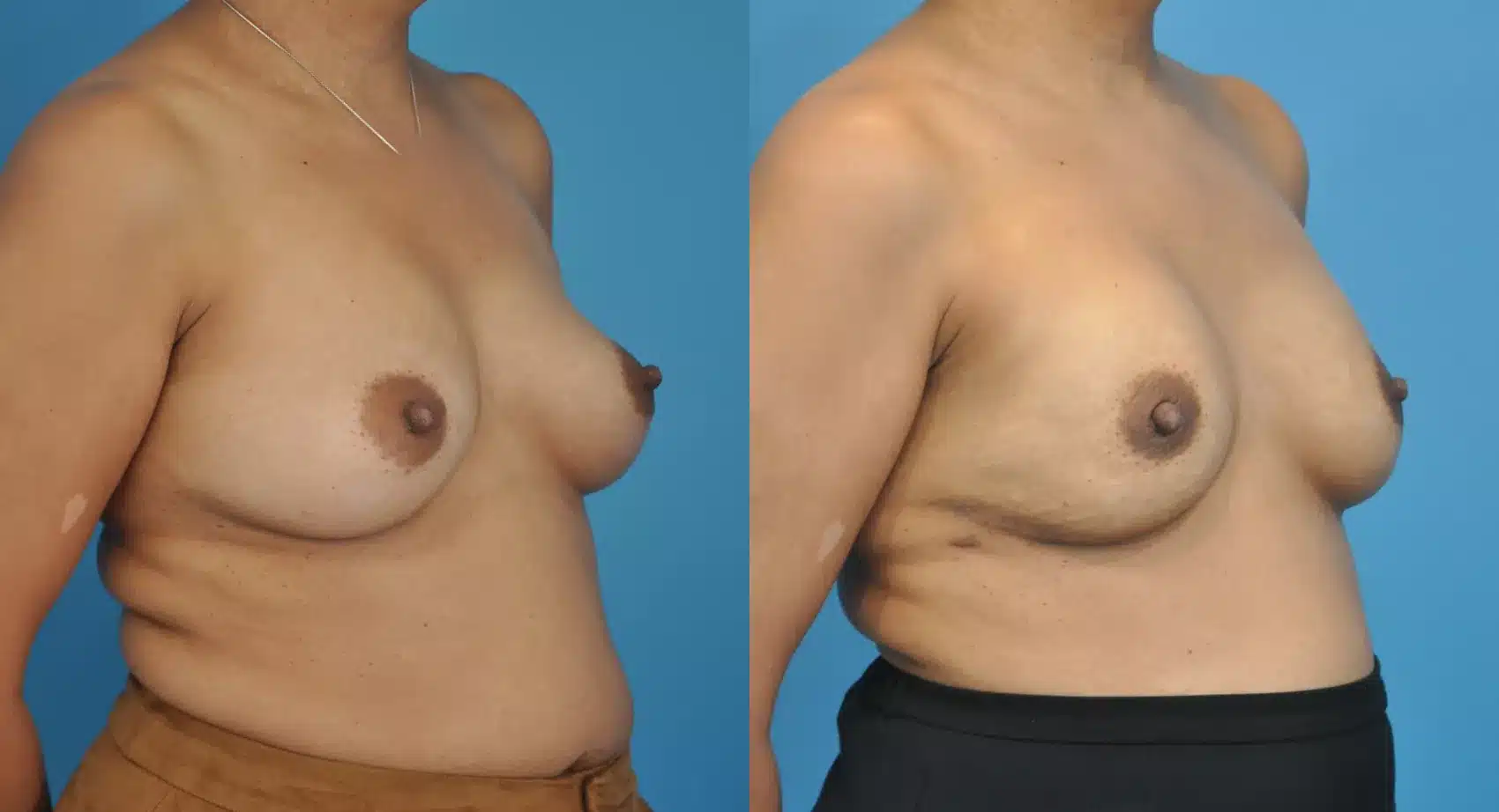 Before and After Image: Case #74 - right-front-oblique