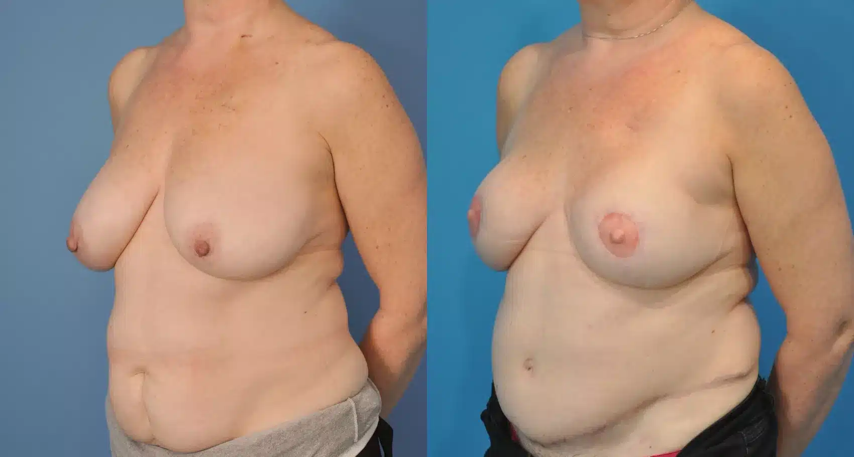 Before and After Image: Case #75 - left-front-oblique