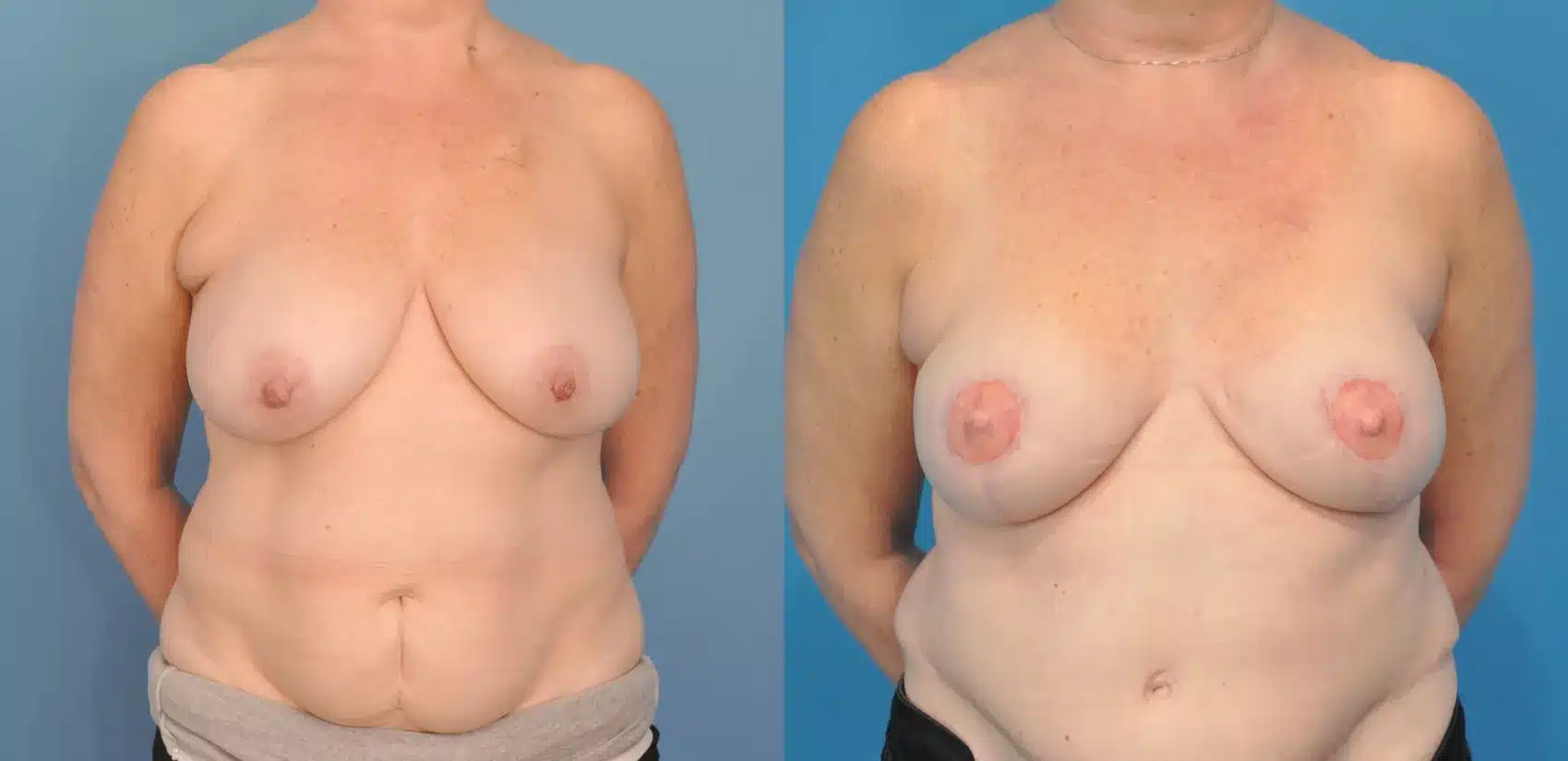 Before and After Image: Case #75 - front