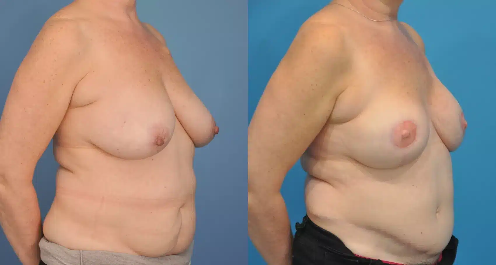 Before and After Image: Case #75 - right-front-oblique