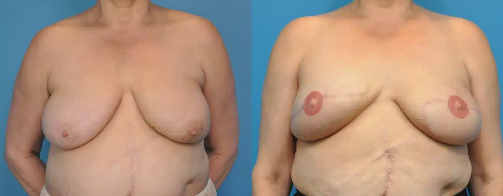 Before and After Image: Case #77 - front