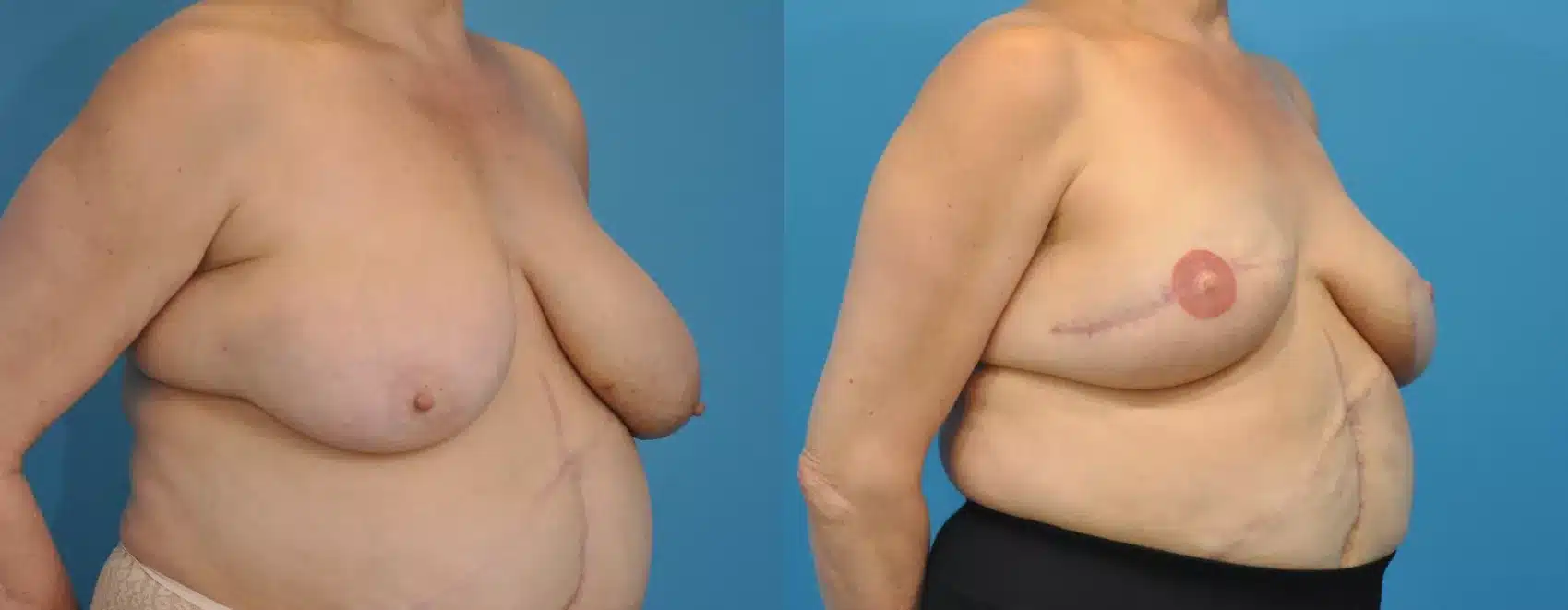 Before and After Image: Case #77 - right-front-oblique