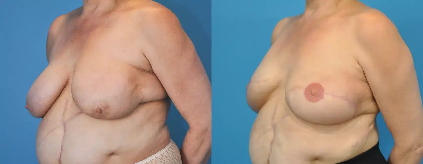 Before and After Image: Case #77 - left-front-oblique
