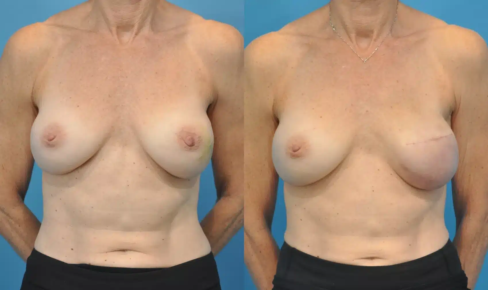 Before and After Image: Case #78 - front