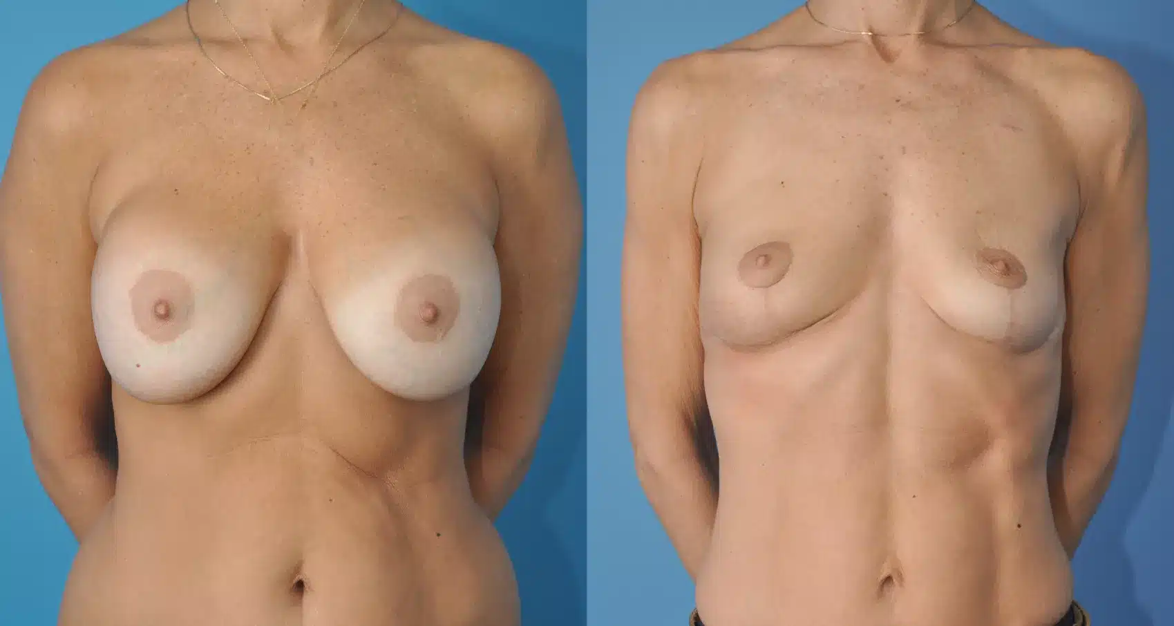 Before and After Image: Case #80 - front