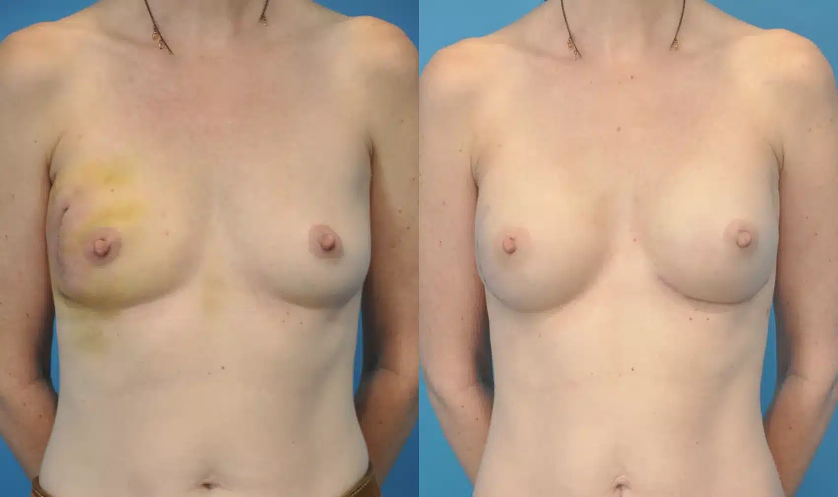 Before and After Image: Case #81 - front
