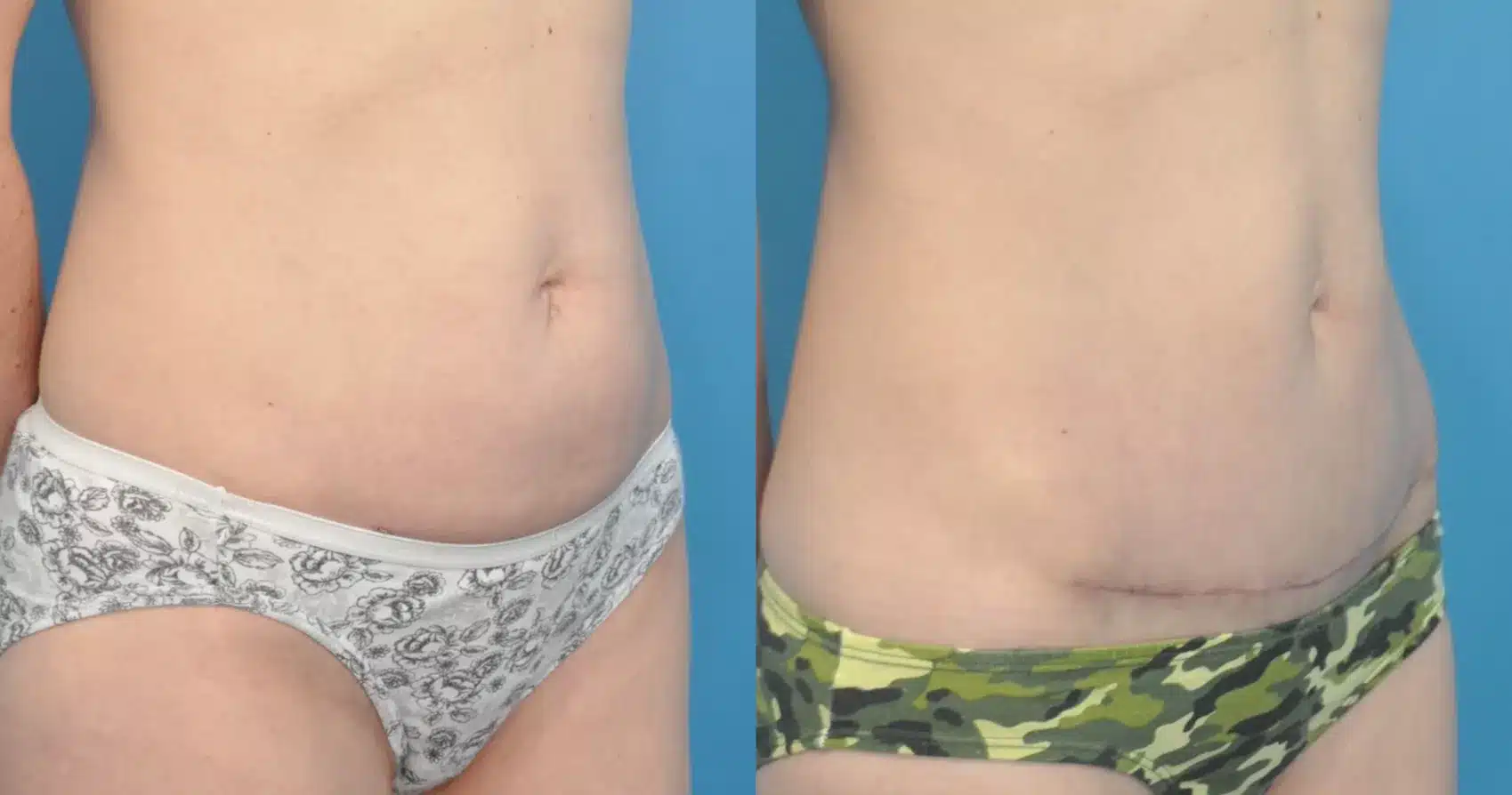 Before and After Image: Case #82 - right-front-oblique