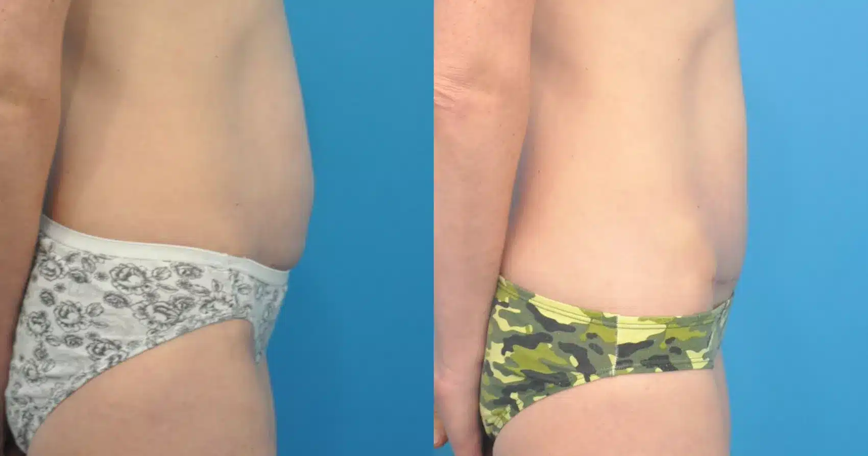 Before and After Image: Case #82 - right-side