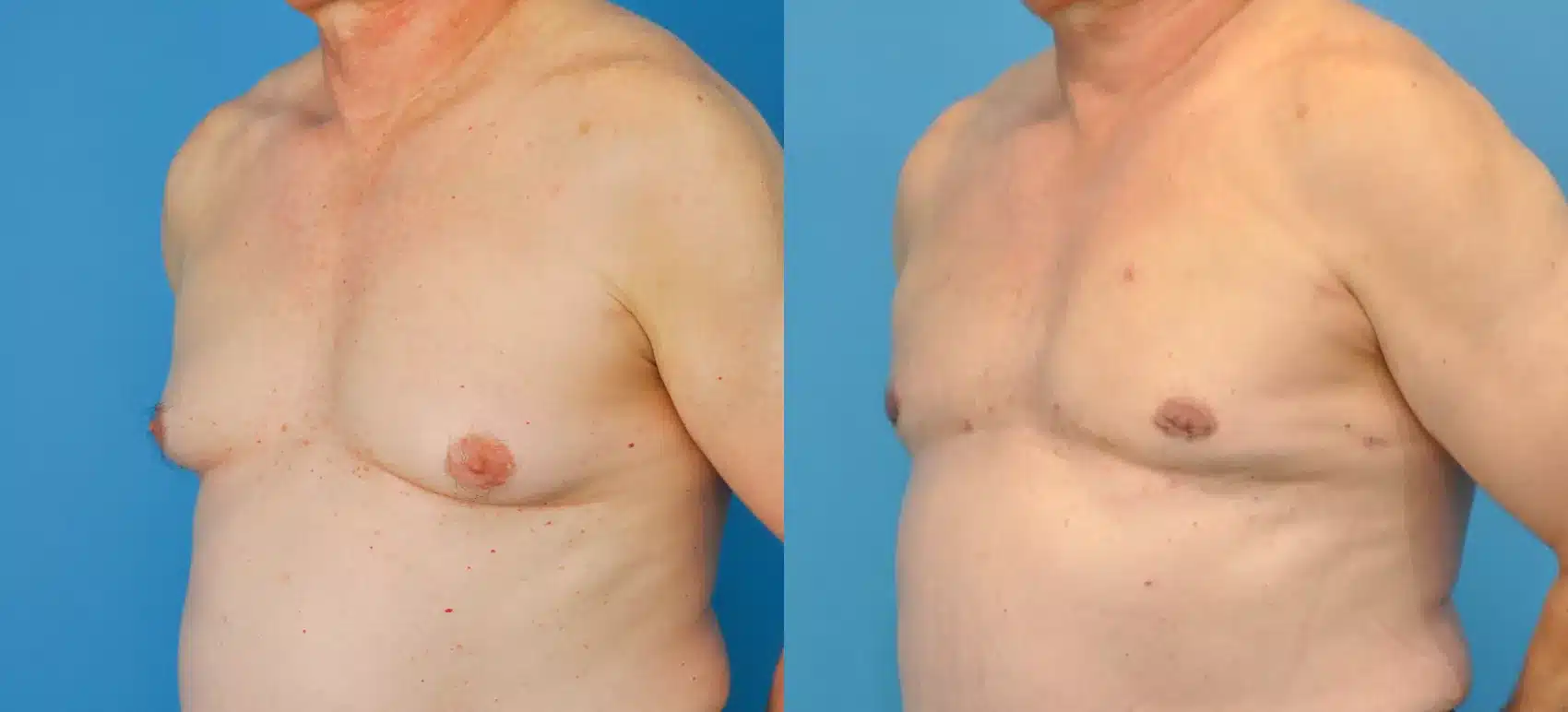 Before and After Image: Case #84 - left-front-oblique