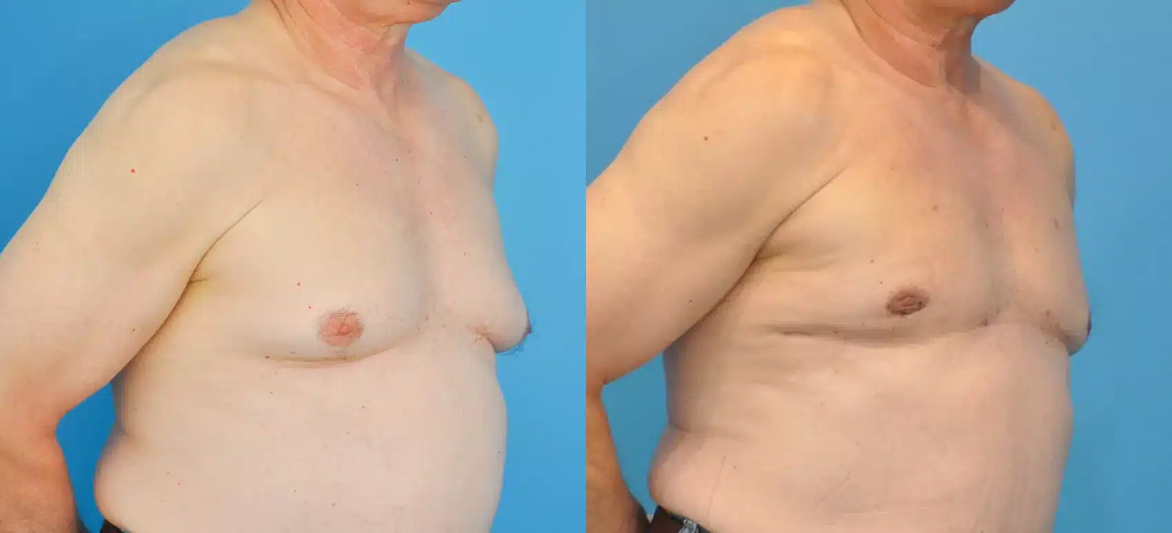 Before and After Image: Case #84 - right-front-oblique