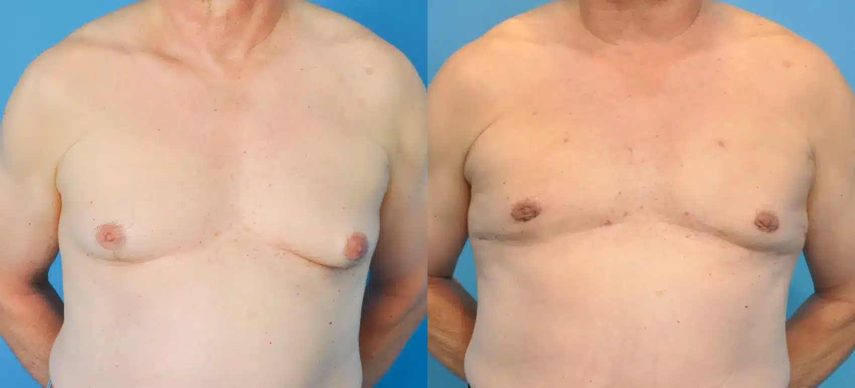 Before and After Image: Case #84 - front