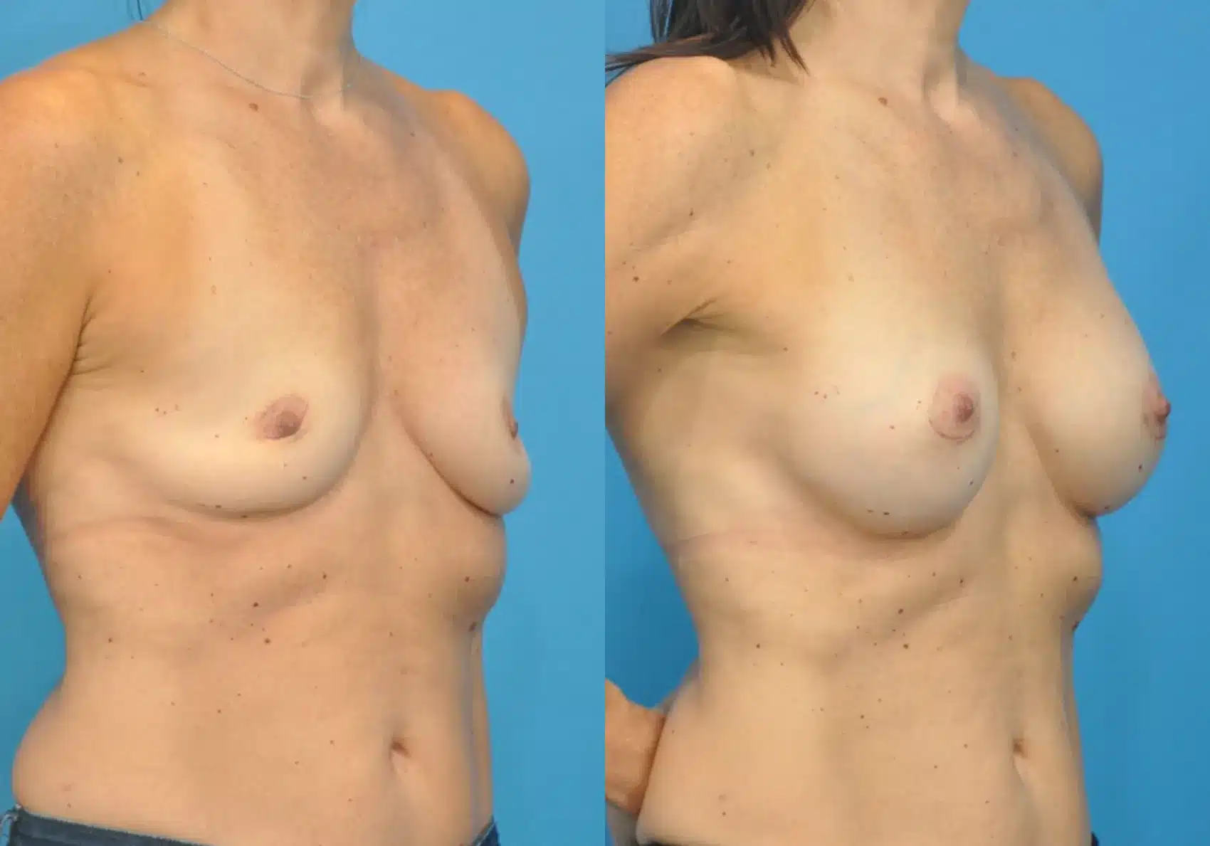 Before and After Image: Breast Augmentation 215/255 ml Silicone - right-front-oblique
