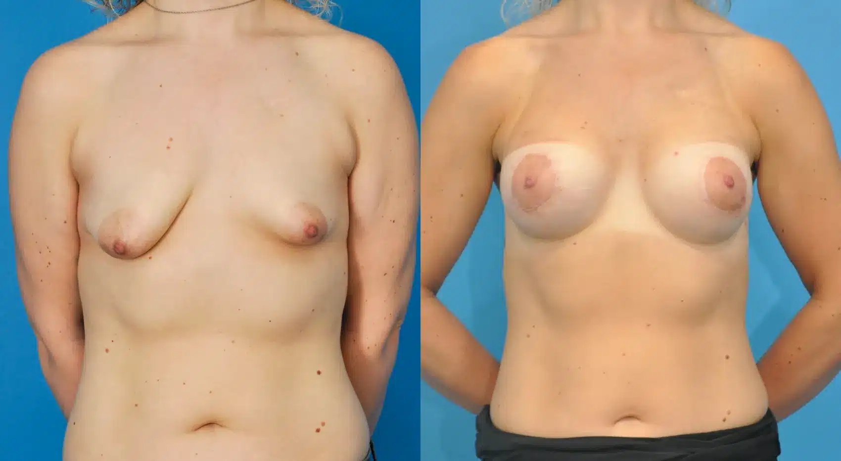 Before and After Image: Breast Augmentation with Lift - front