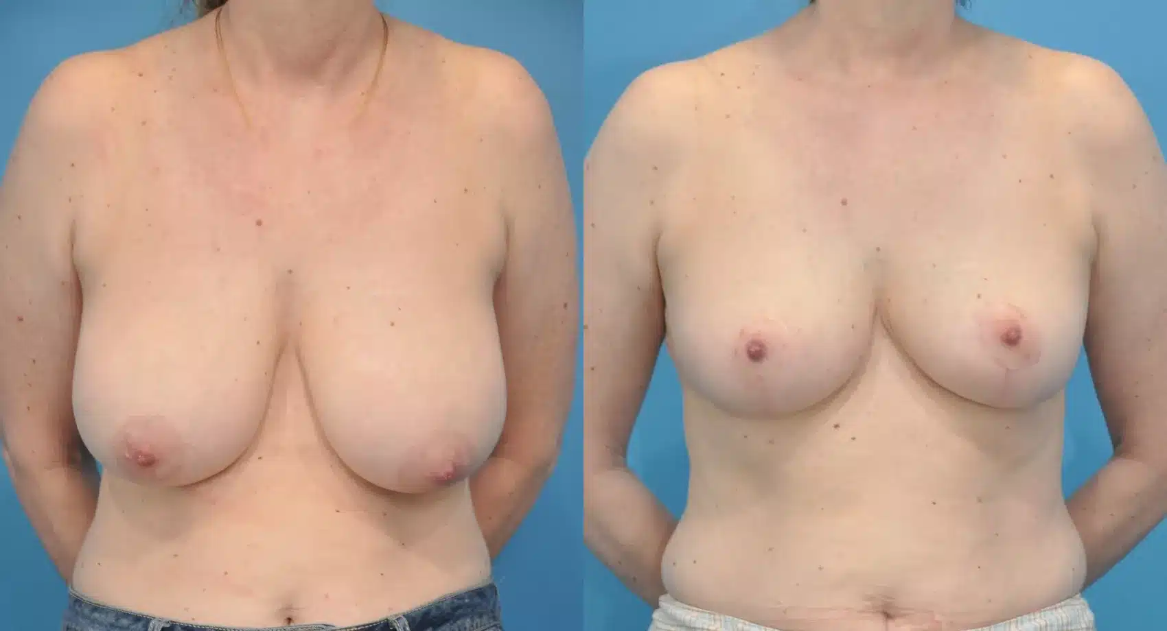 Before and After Image: Case #91 - front