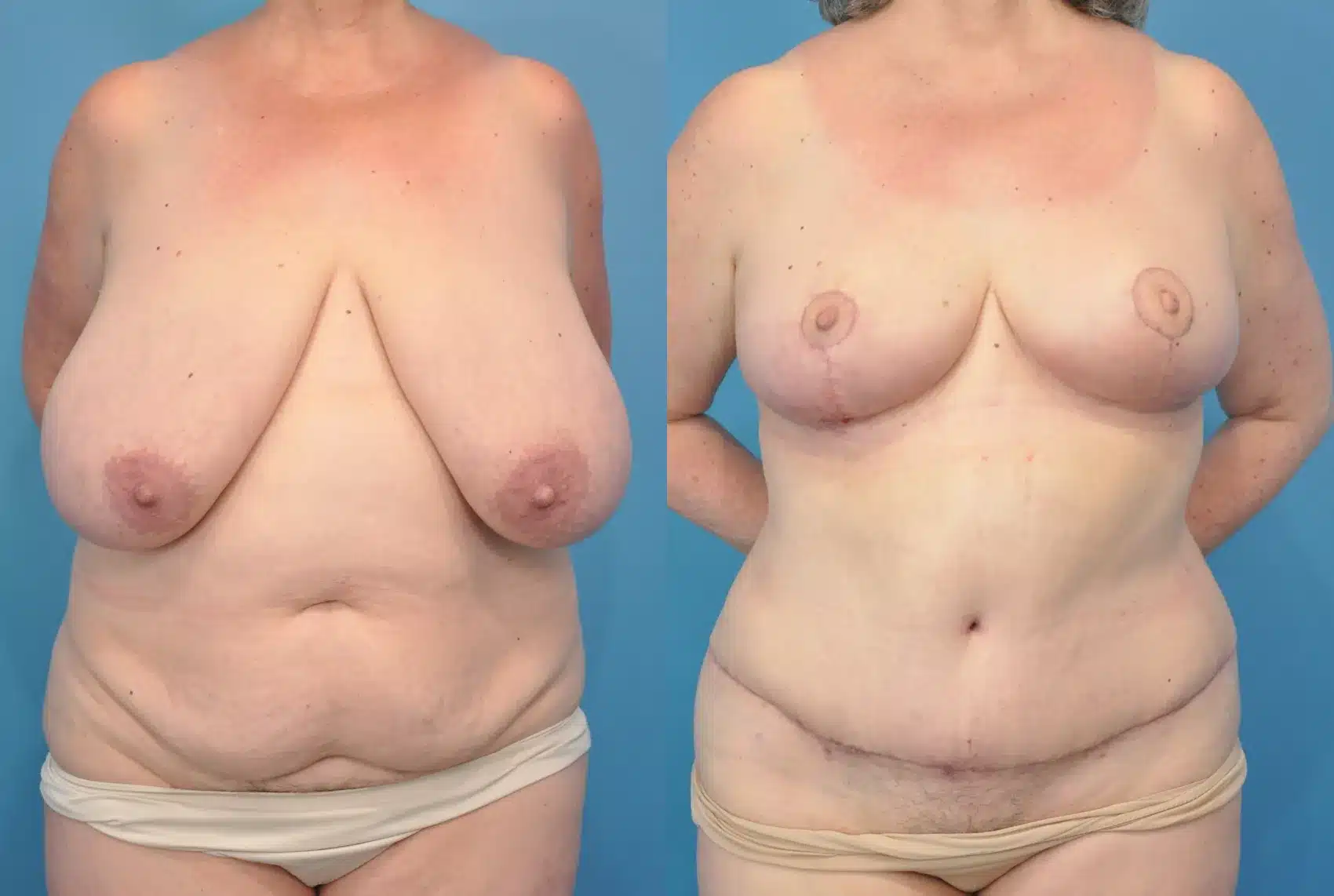 Before and After Image: Breast Reduction/Lift and Tummy Tuck - front