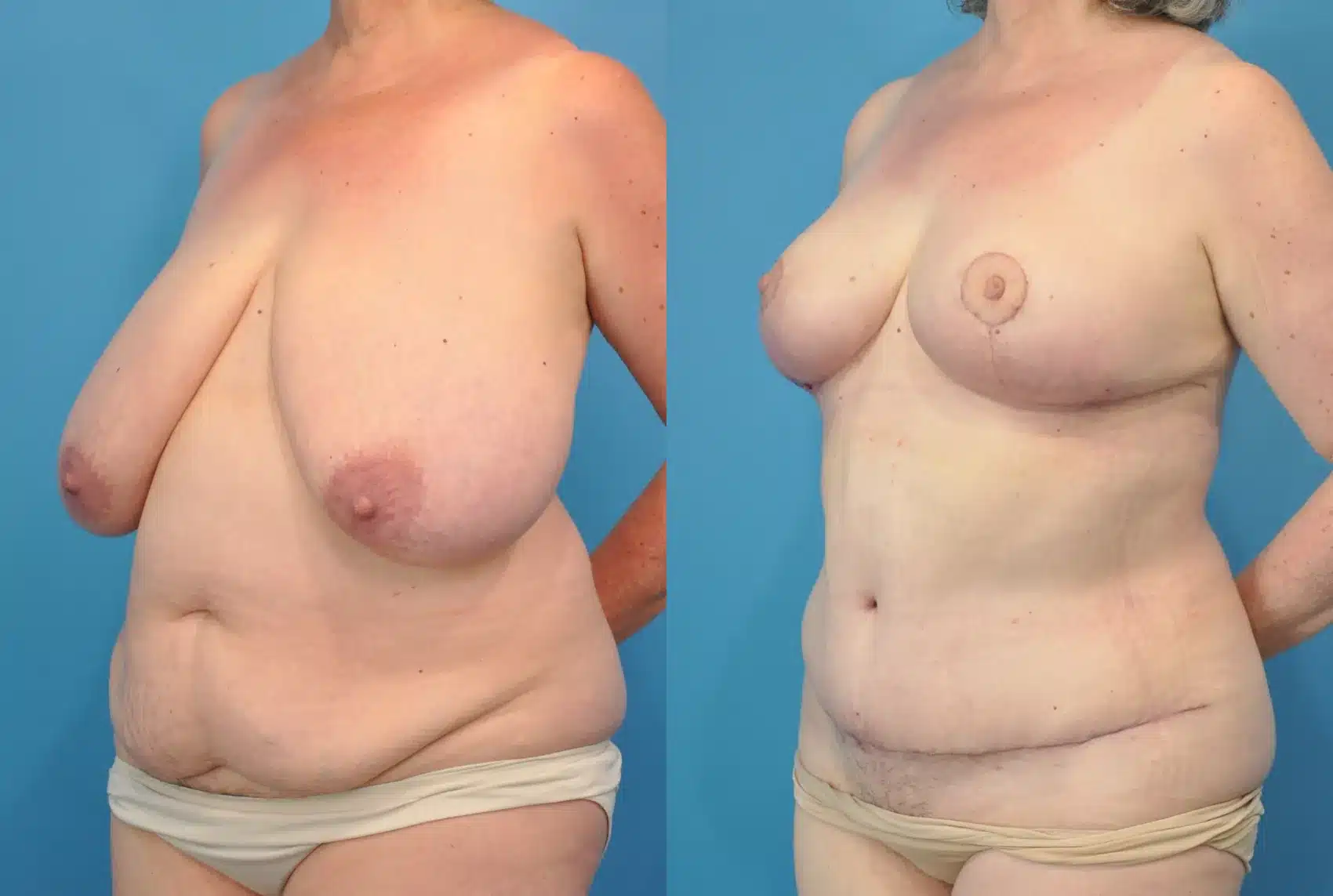 Before and After Image: Breast Reduction/Lift and Tummy Tuck - left-front-oblique