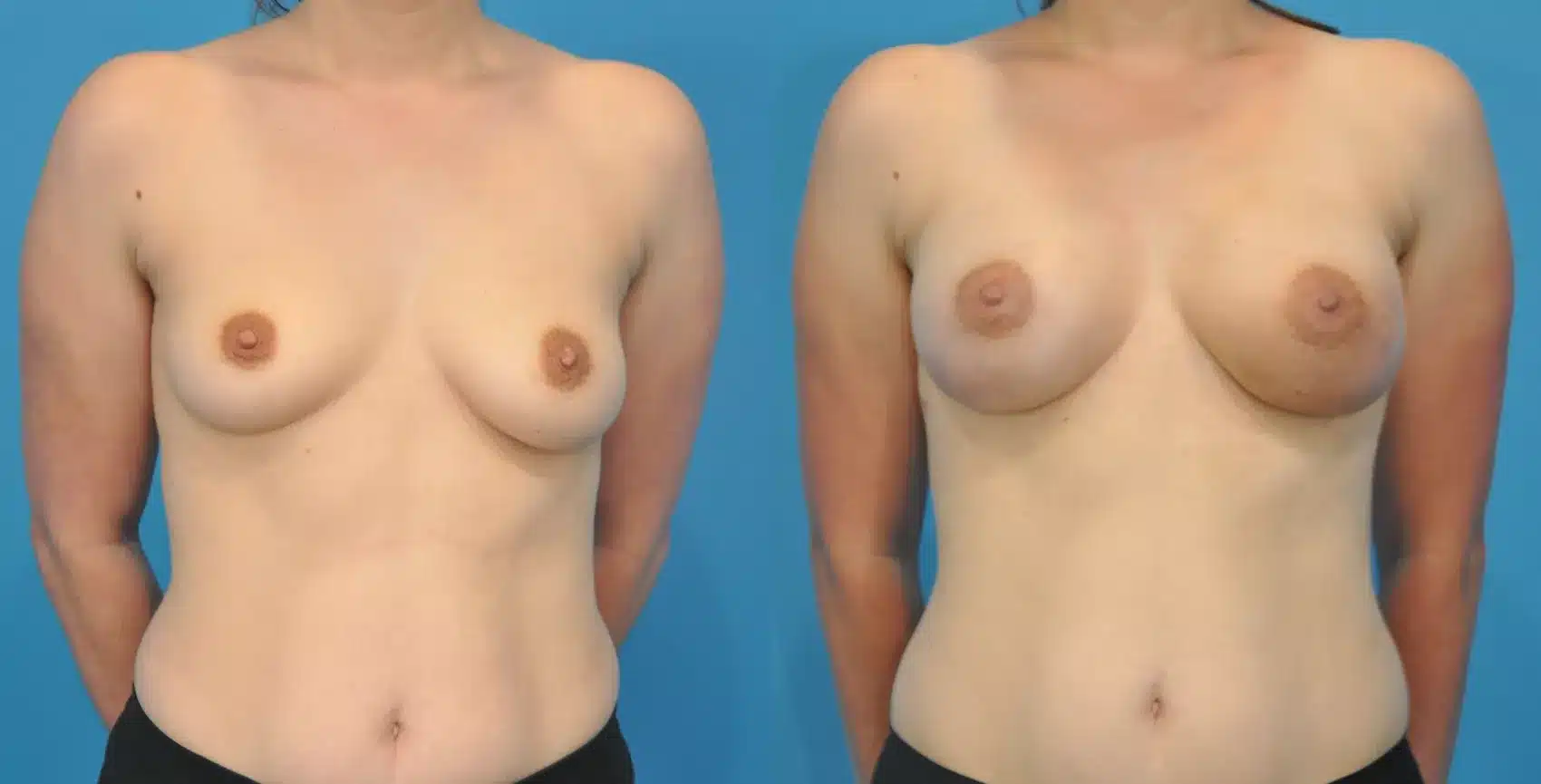 Before and After Image: Case #93 - front