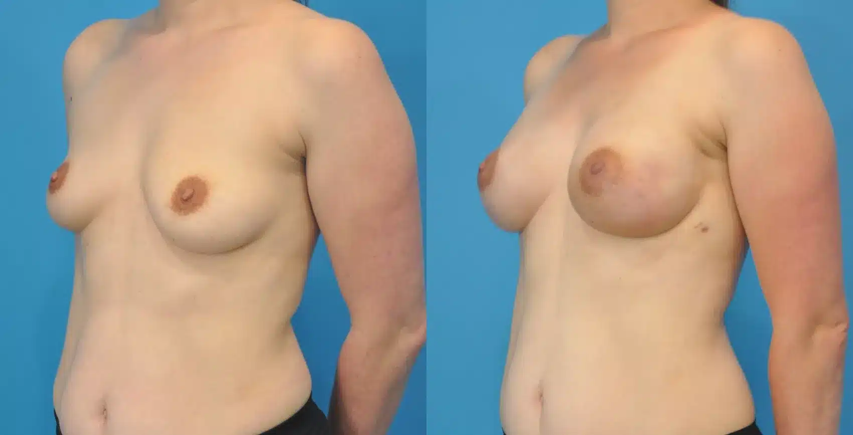 Before and After Image: Case #93 - left-front-oblique