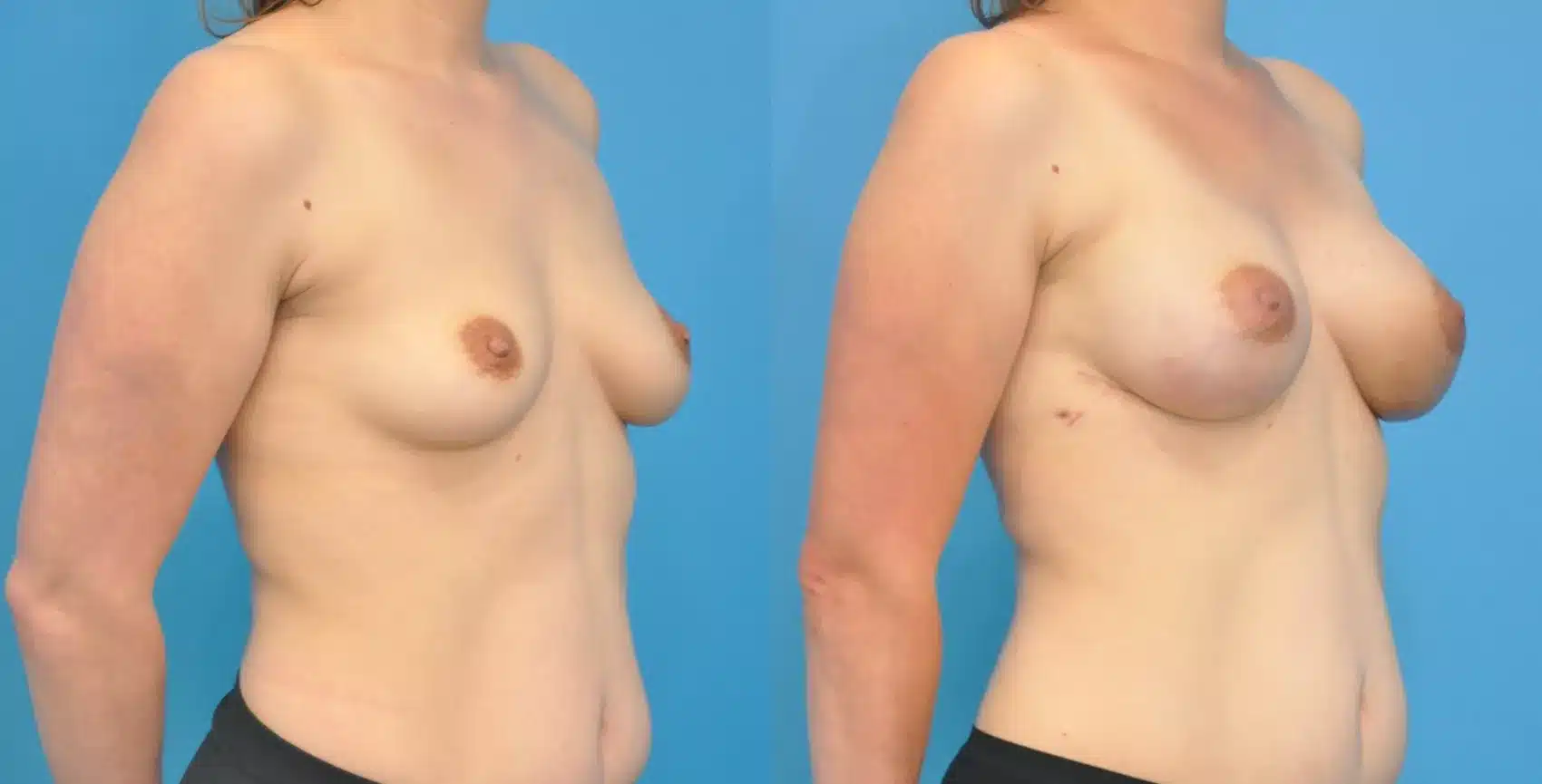Before and After Image: Case #93 - right-front-oblique