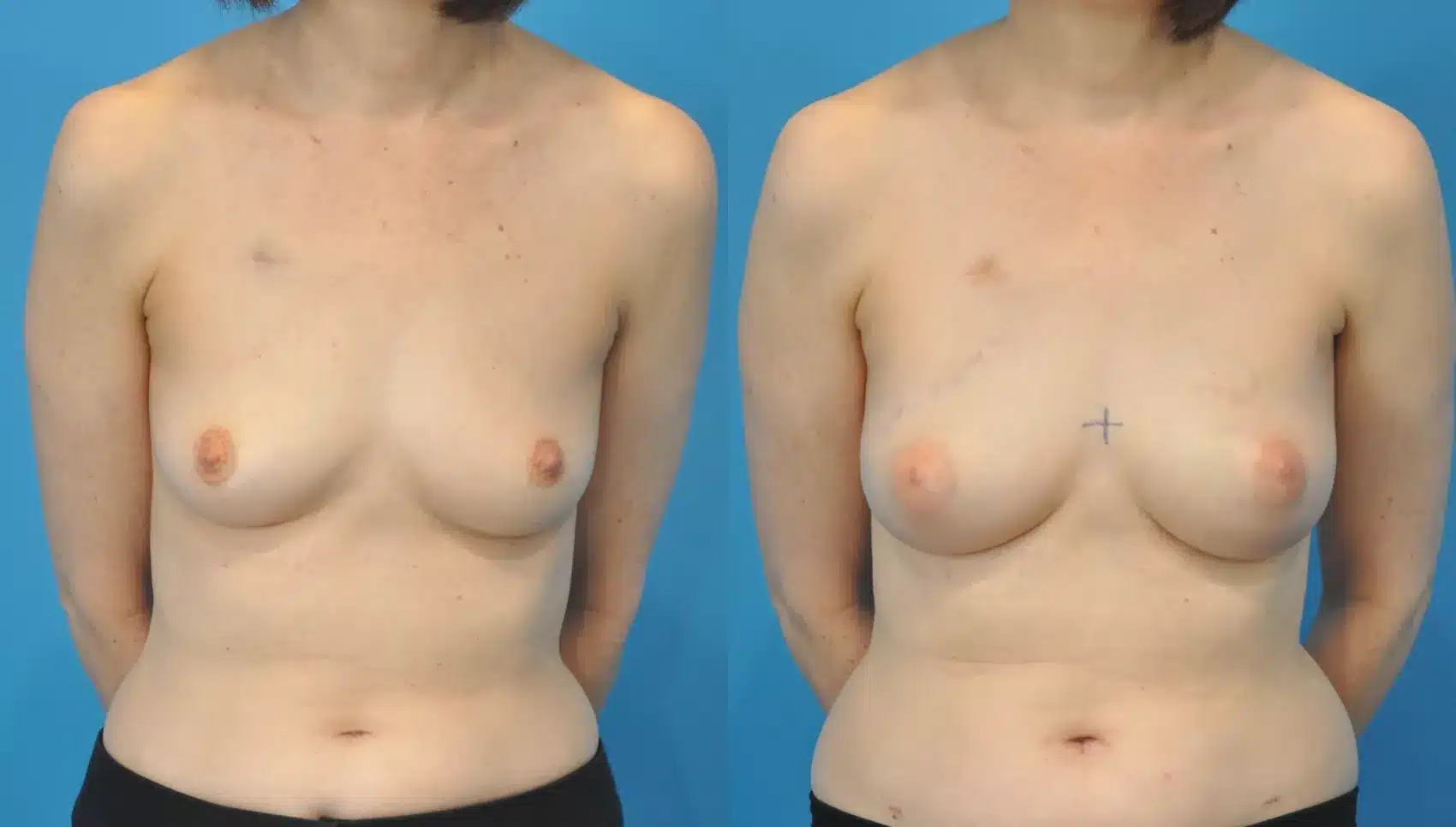 Before and After Image: Case #94 - front