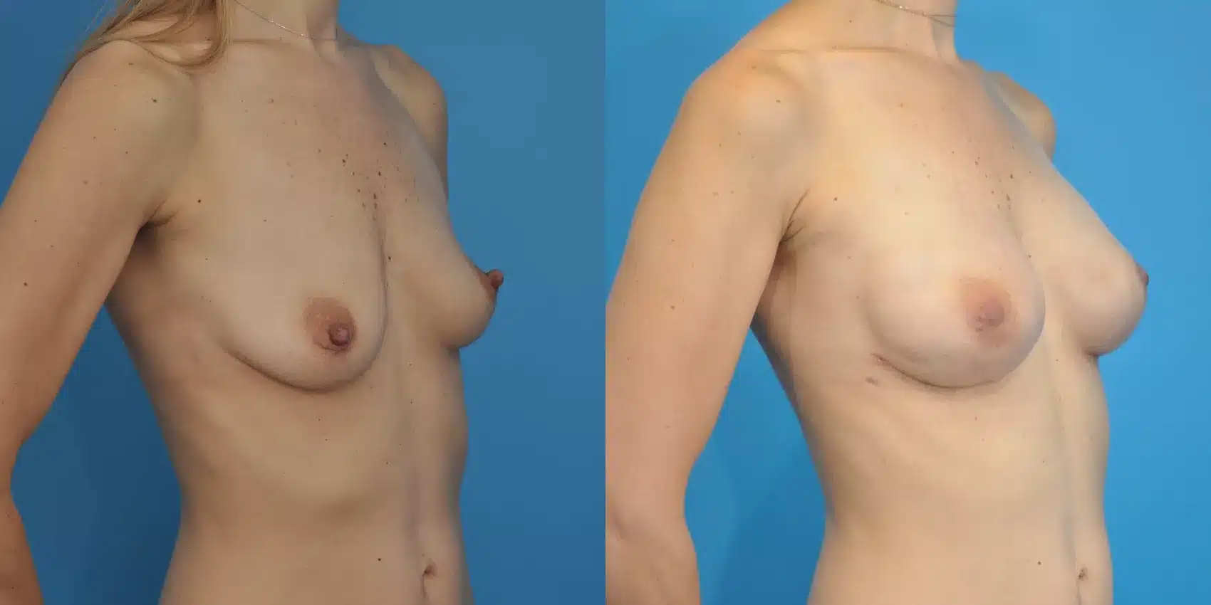 Before and After Image: Case #97 - right-front-oblique