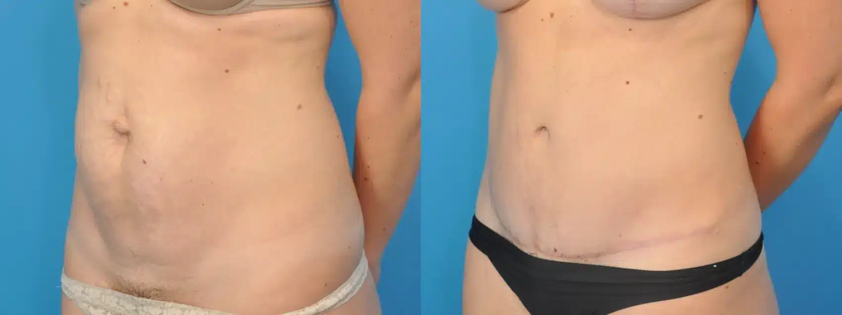Before and After Image: Case #99 - left-front-oblique