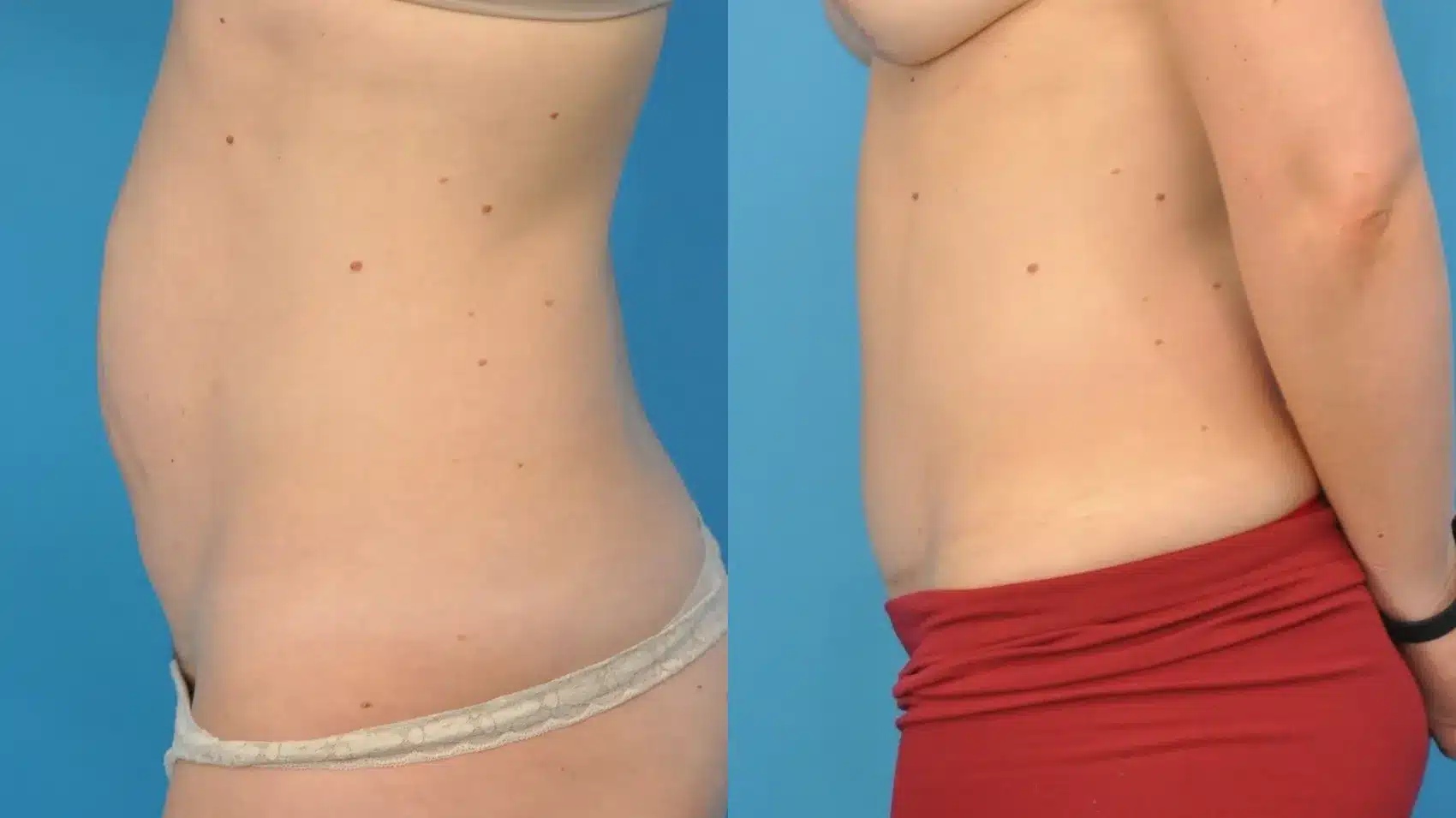 Before and After Image: Case #99 - left-side