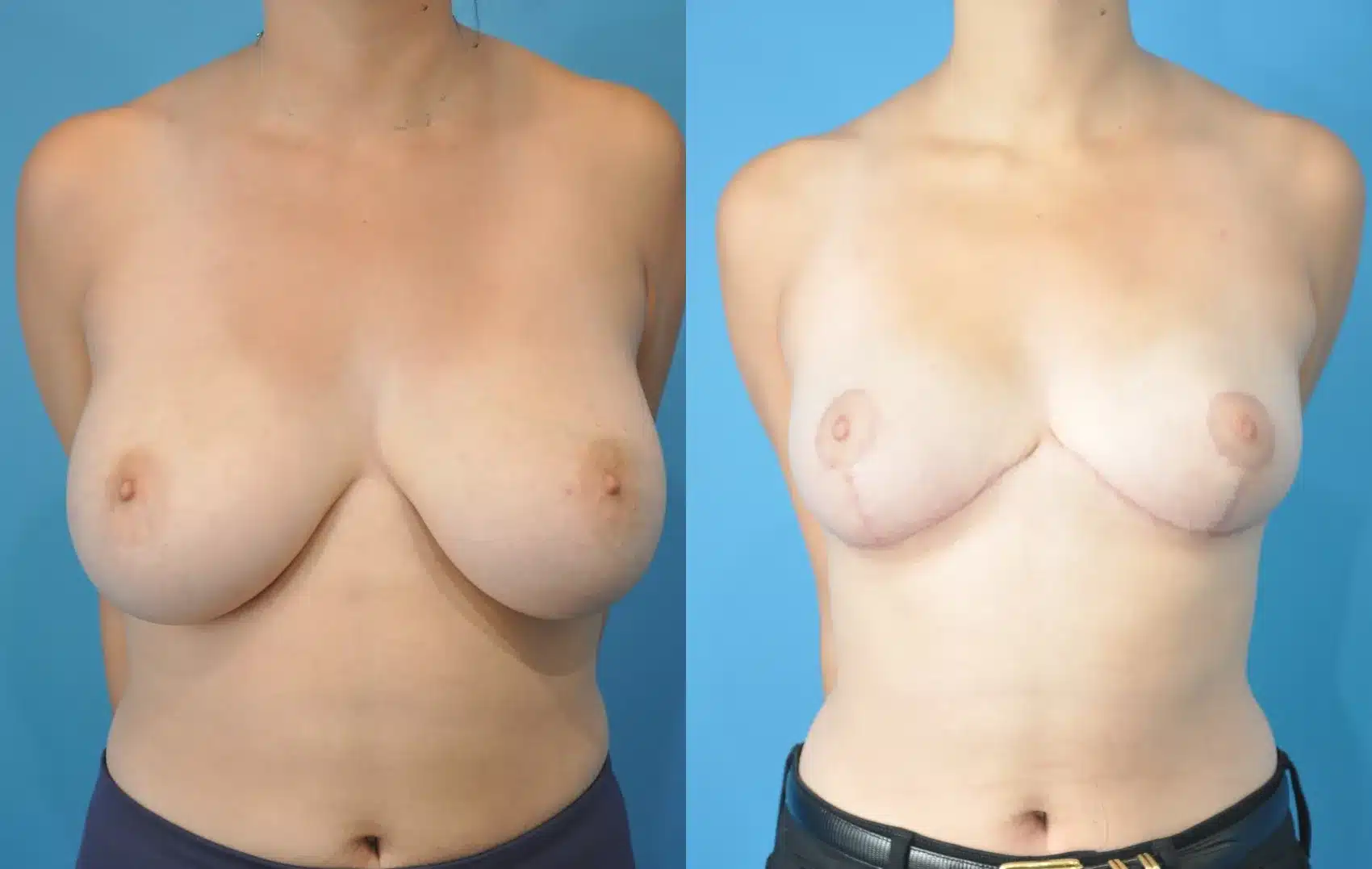Before and After Image: Breast Reduction and Lift - front