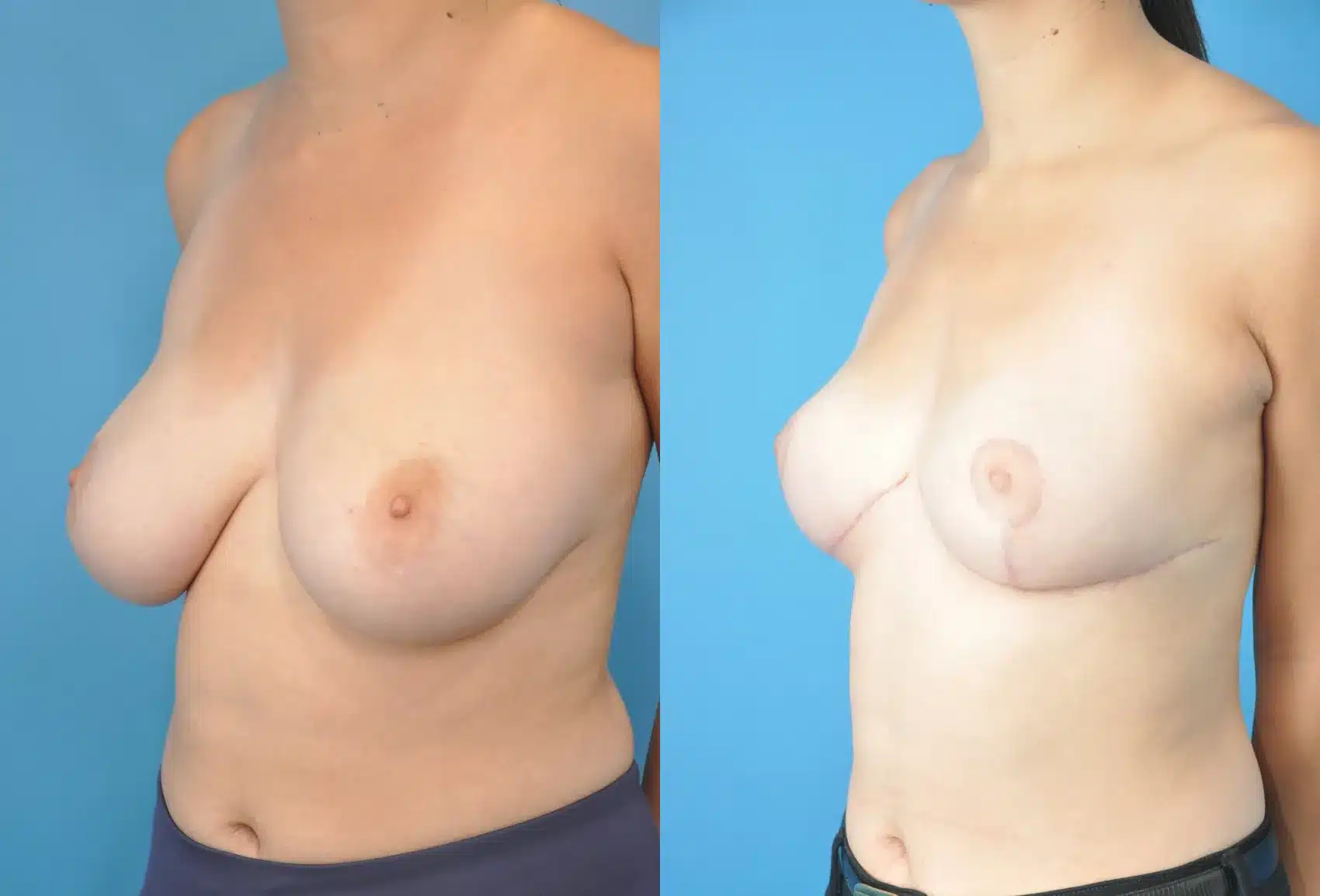 Before and After Image: Breast Reduction and Lift - left-front-oblique
