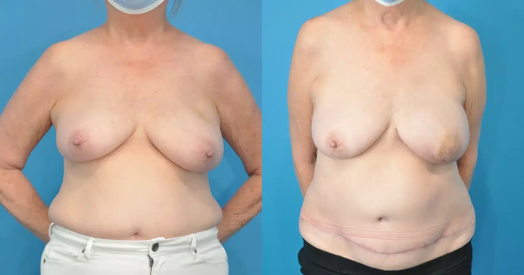 Before and After Image: Case #194 - front