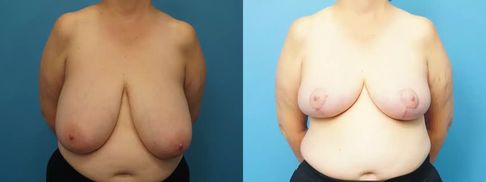 Before and After Image: Case #470 - front