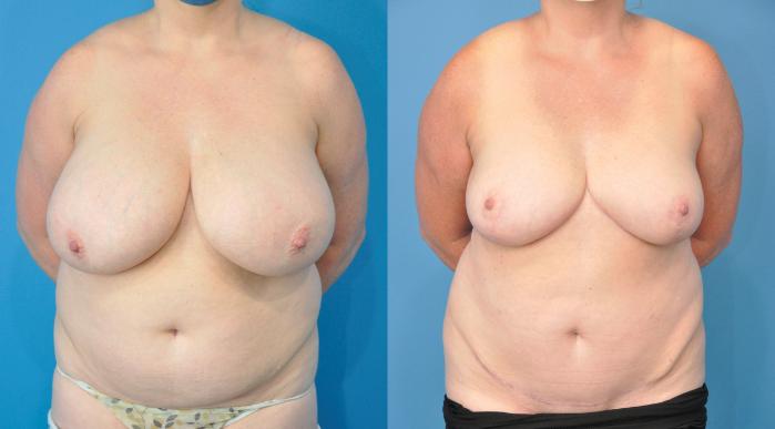 Before and After Image: Mommy Makeover Before & After Case 241 - front