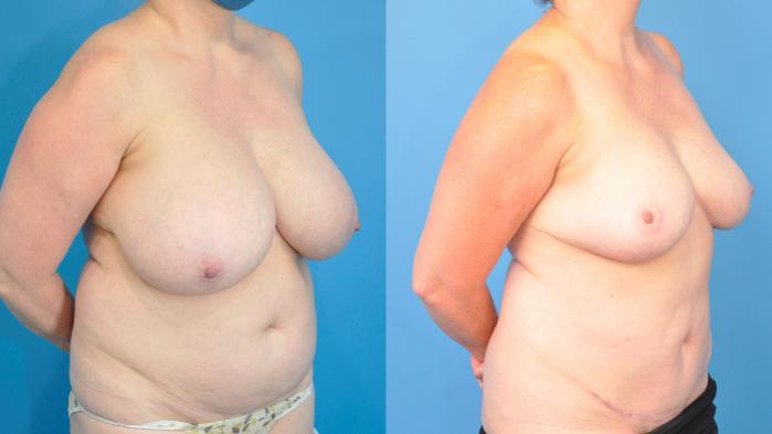 Before and After Image: Mommy Makeover Before & After Case 241 - right-front-oblique