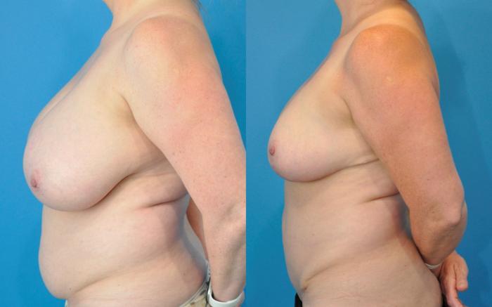 Before and After Image: Mommy Makeover Before & After Case 241 - left-side