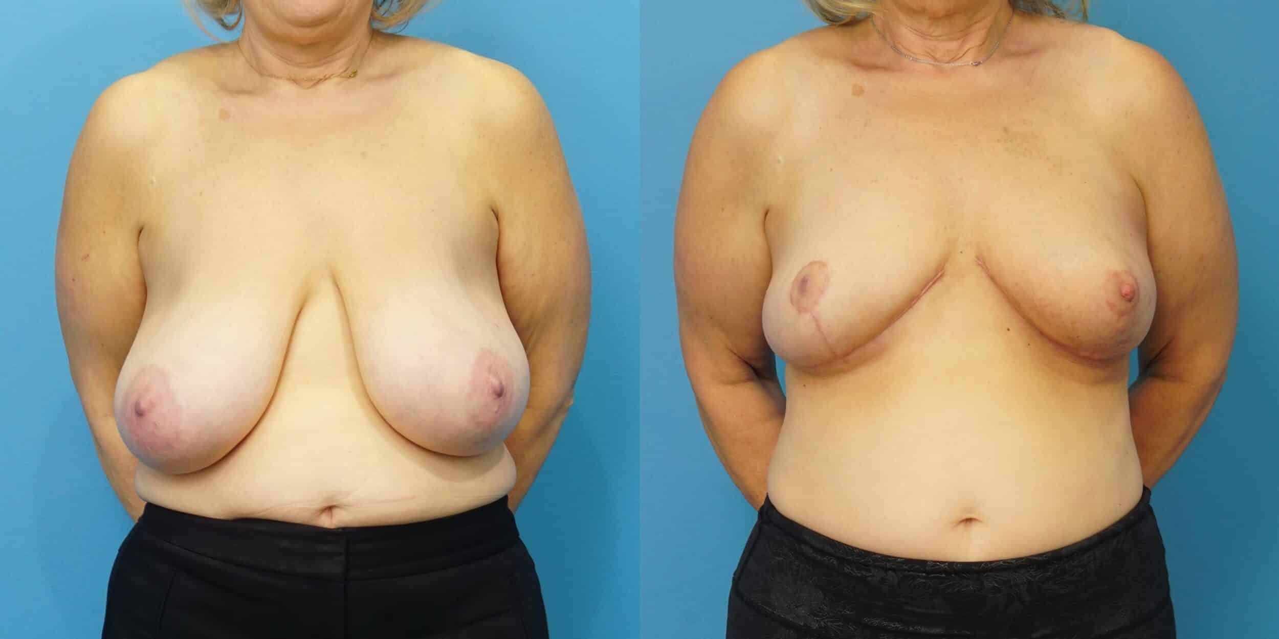 Before and After Image: Oncoplastic Breast Reduction - front