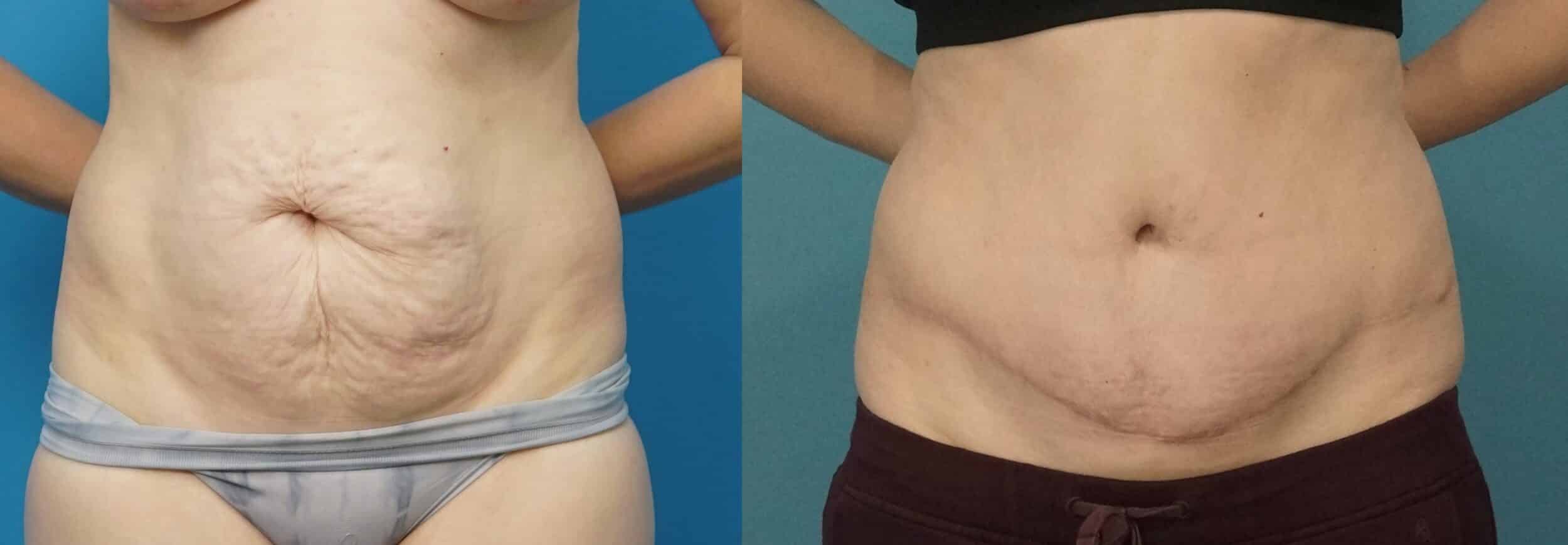 Before and After Image: Abdominoplasty with Flank Liposuction - front