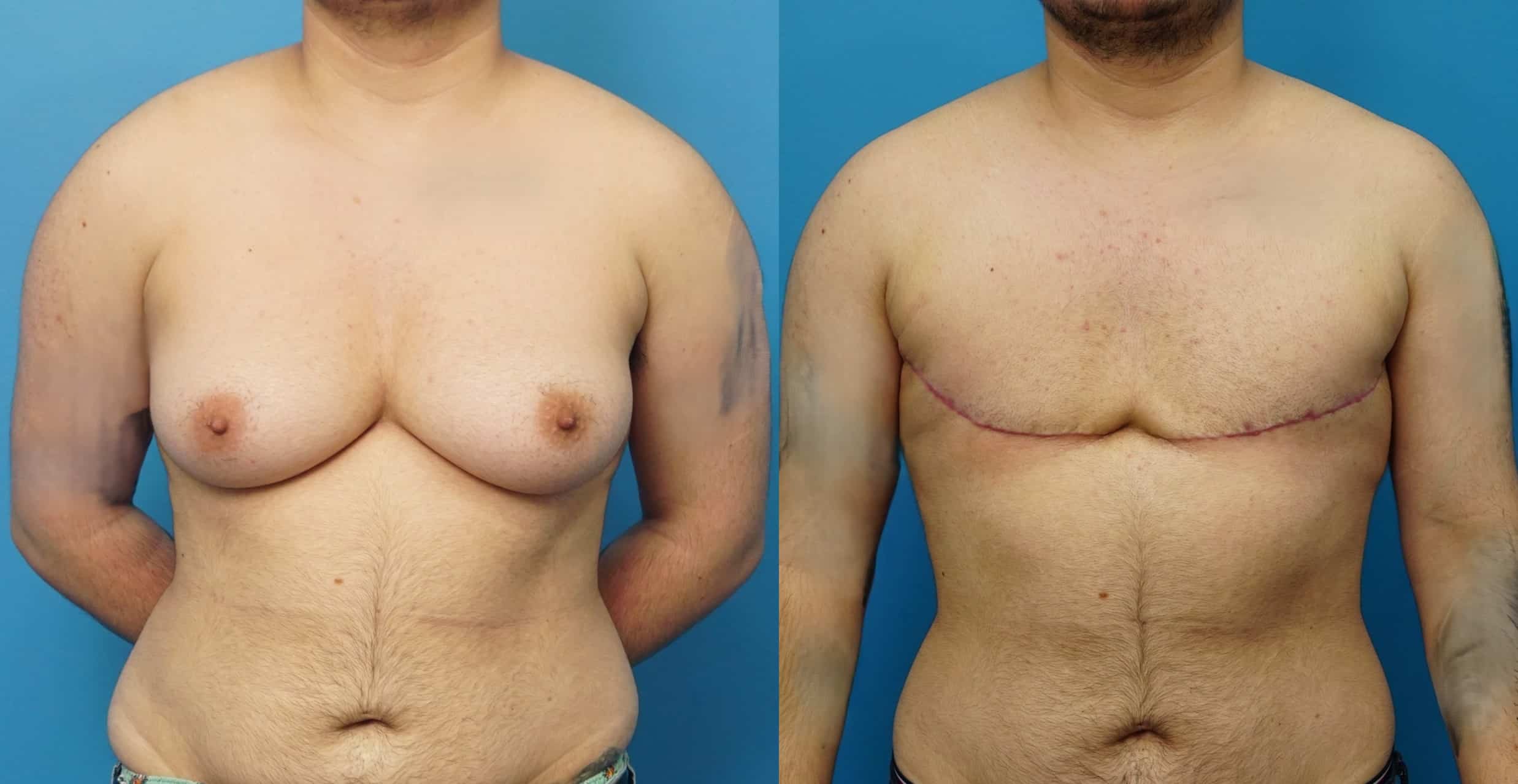 Before and After Image: Gender Affirming Mastectomy