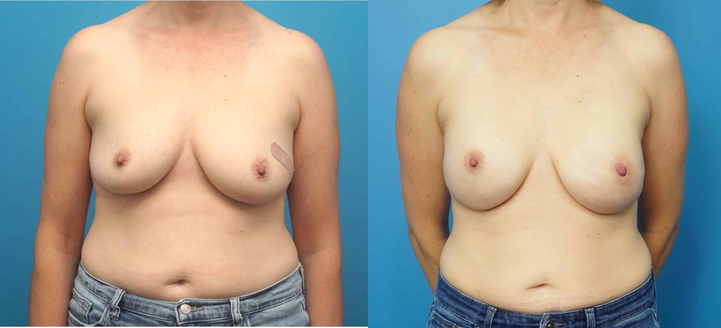 Before and After Image: Breast Reconstruction with Tissue Expanders - front