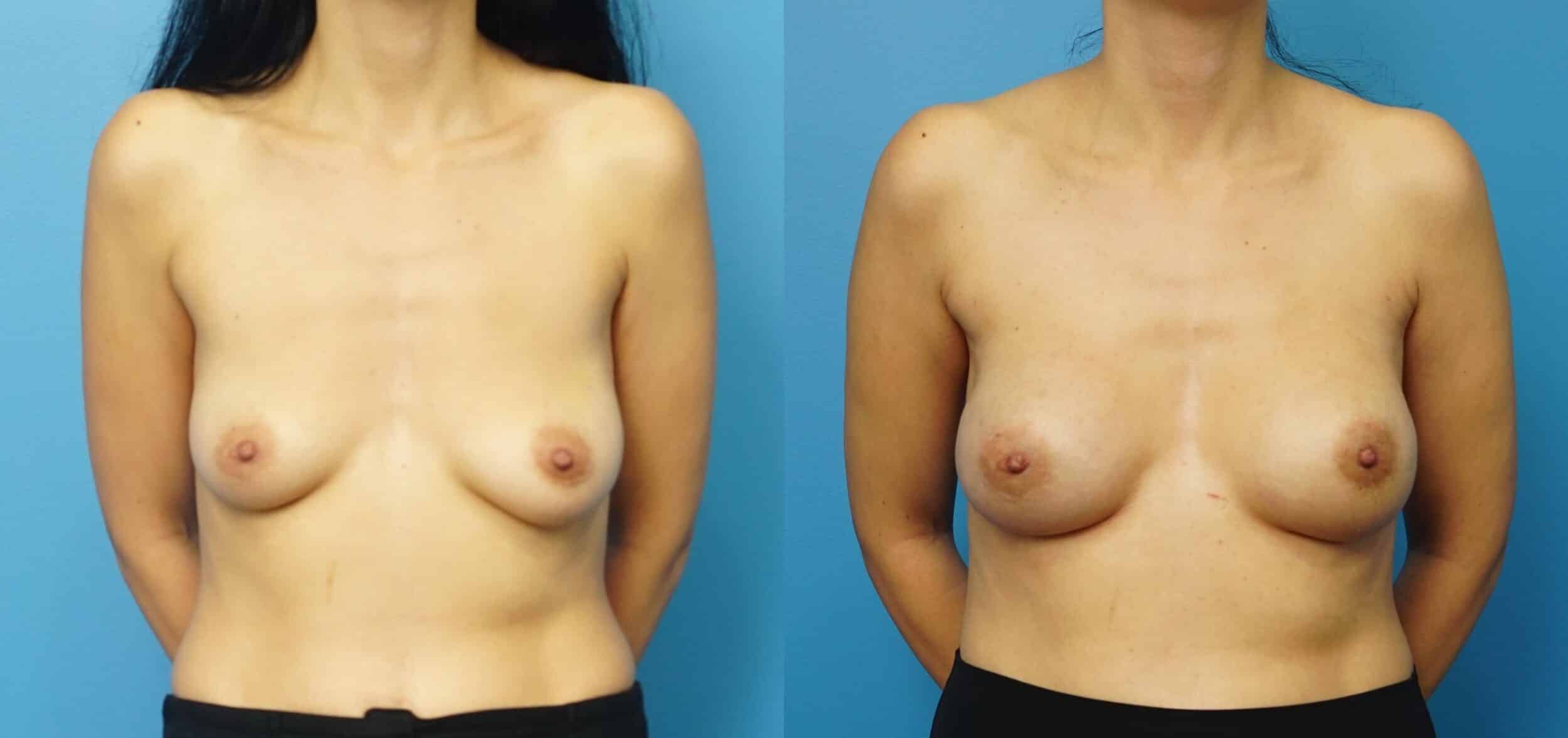 Before and After Image: Breast Reconstruction with Retropectoral Tissue Expander - front