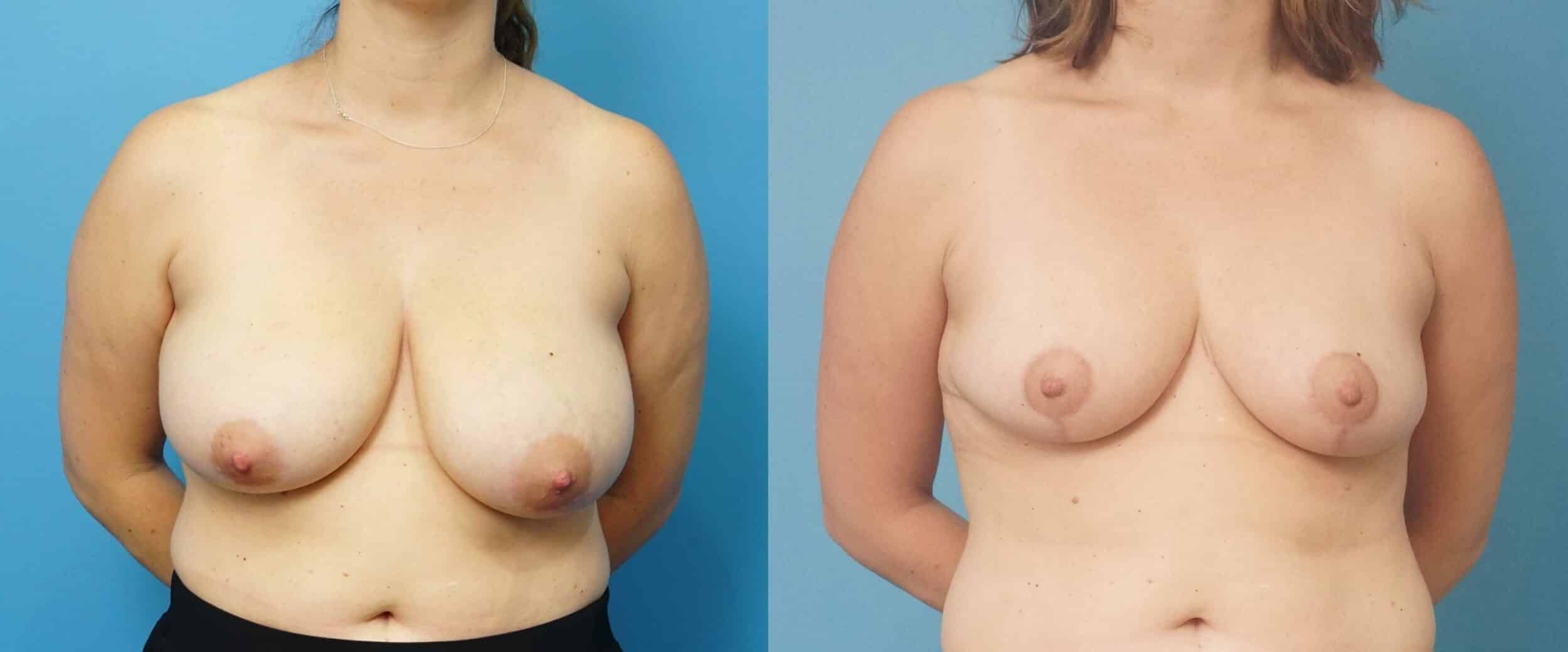 Before and After Image: Breast Reduction and Lift - front