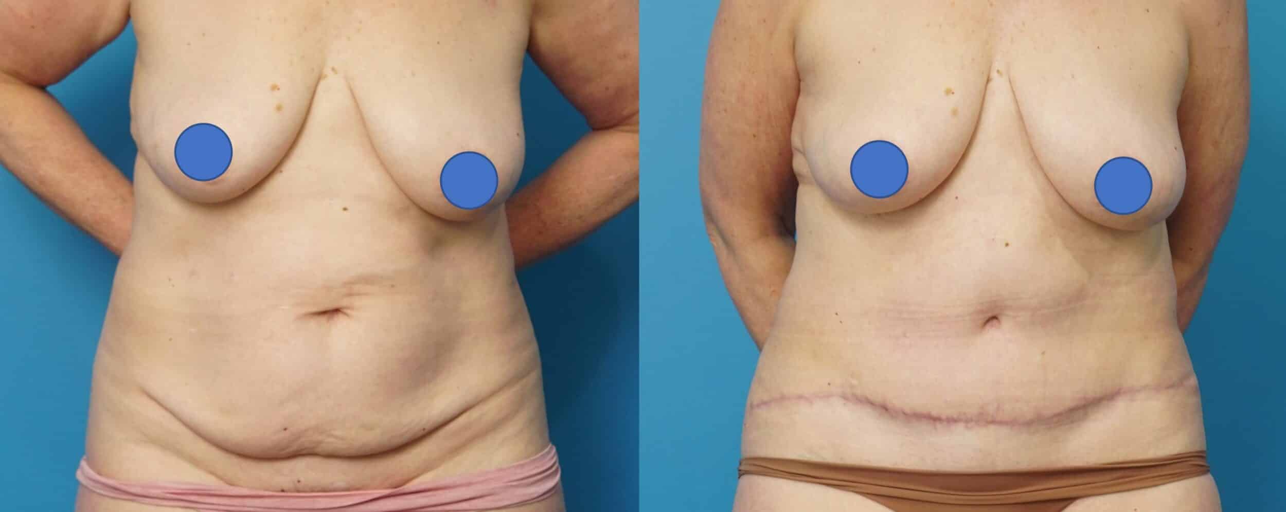 Before and After Image: Abdominoplasty with Flank Liposuction - front