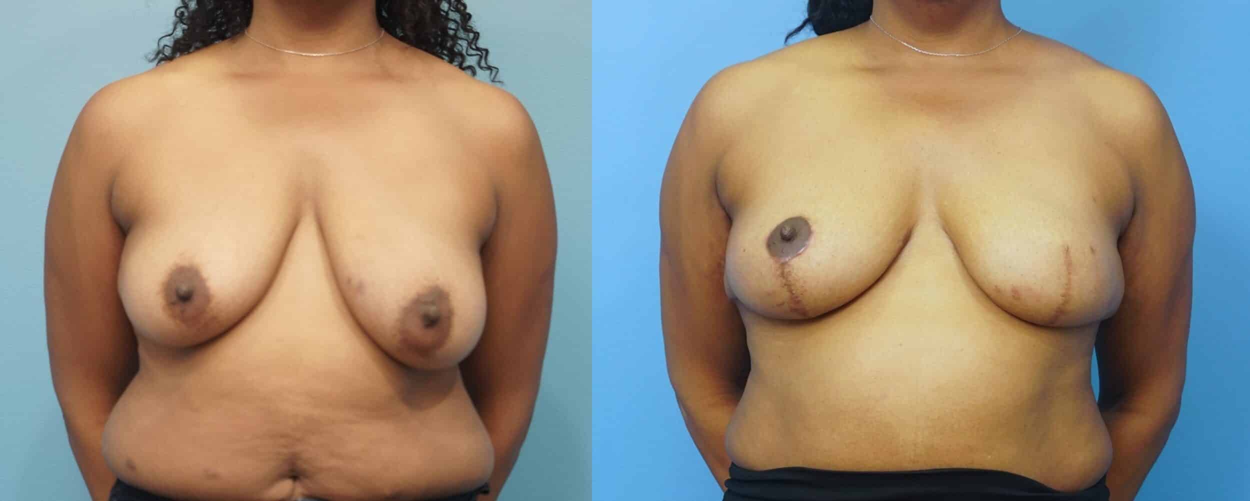 Before and After Image: Breast Reconstruction with Implant and Reduction for Symmetry