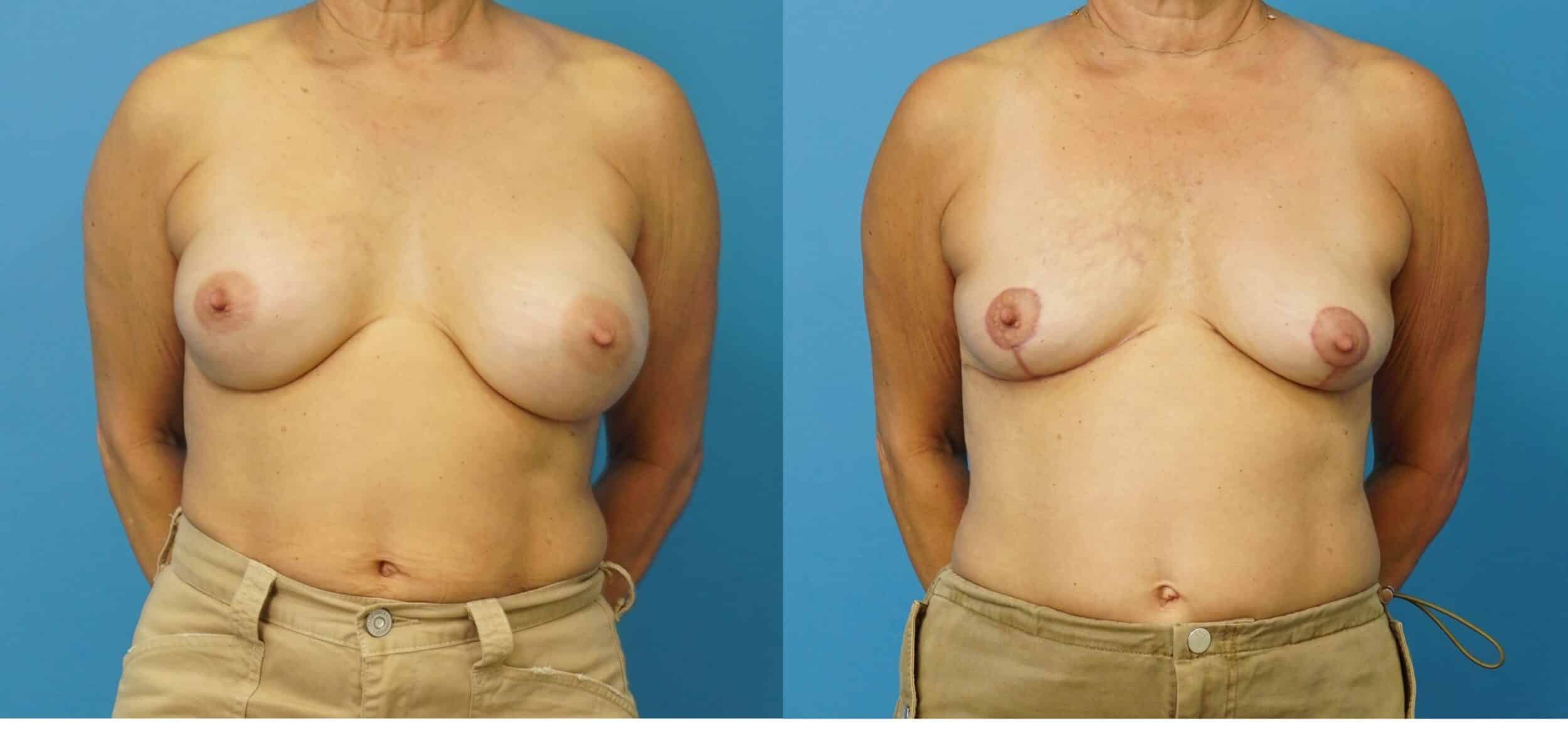 Before and After Image: Implant Removal and Breast Lift