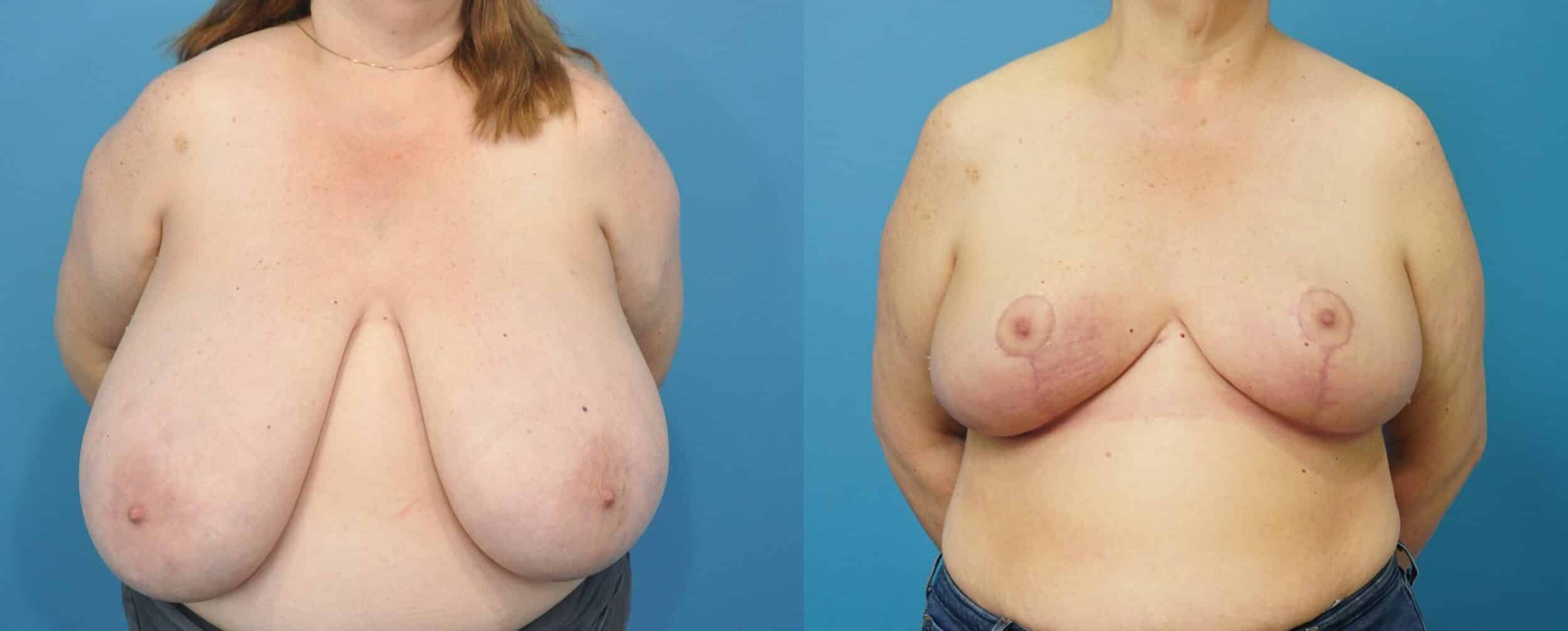 Before and After Image: Massive Breast Reduction - front