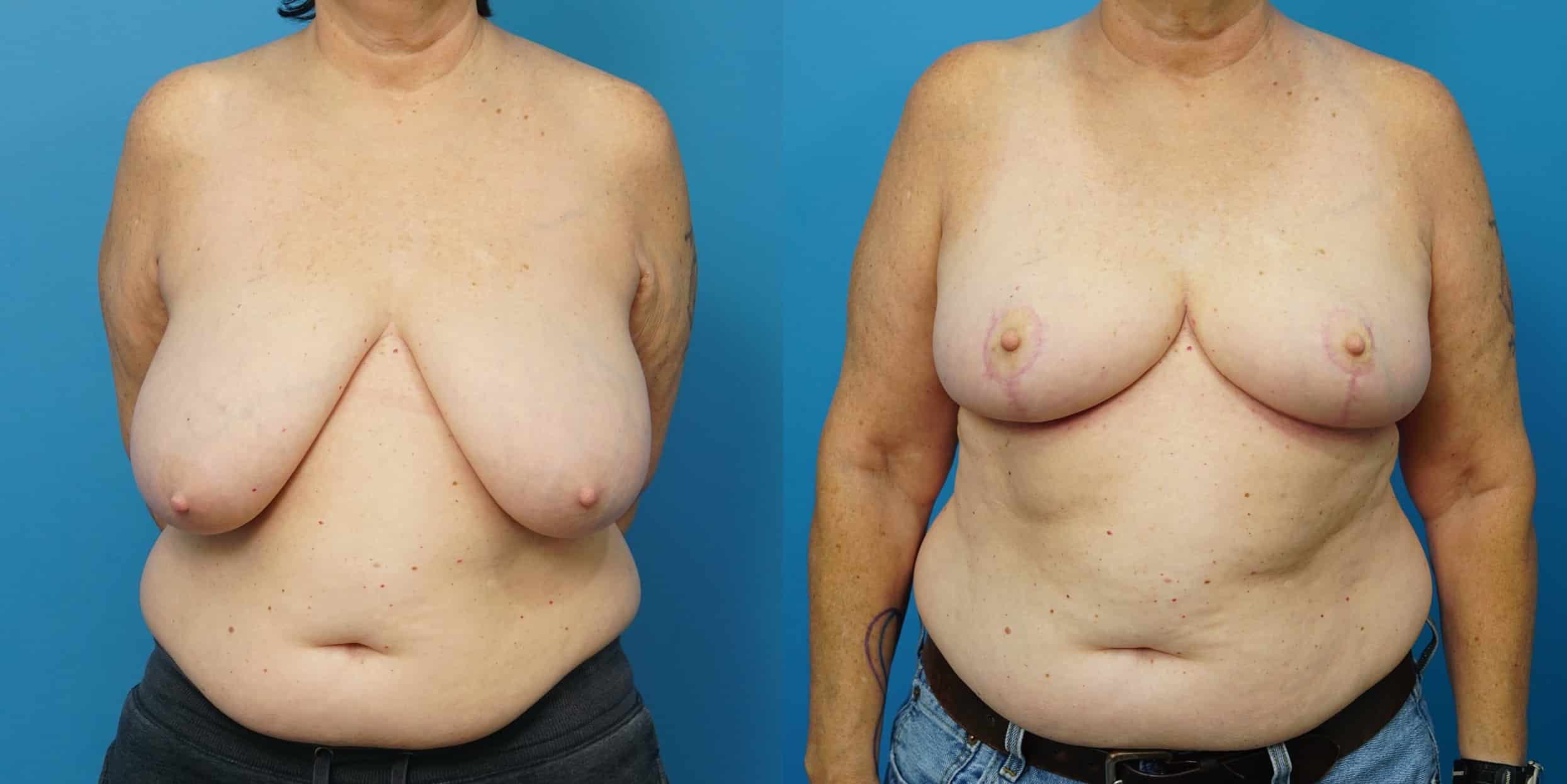 Before and After Image: Breast Reduction and Lift - front
