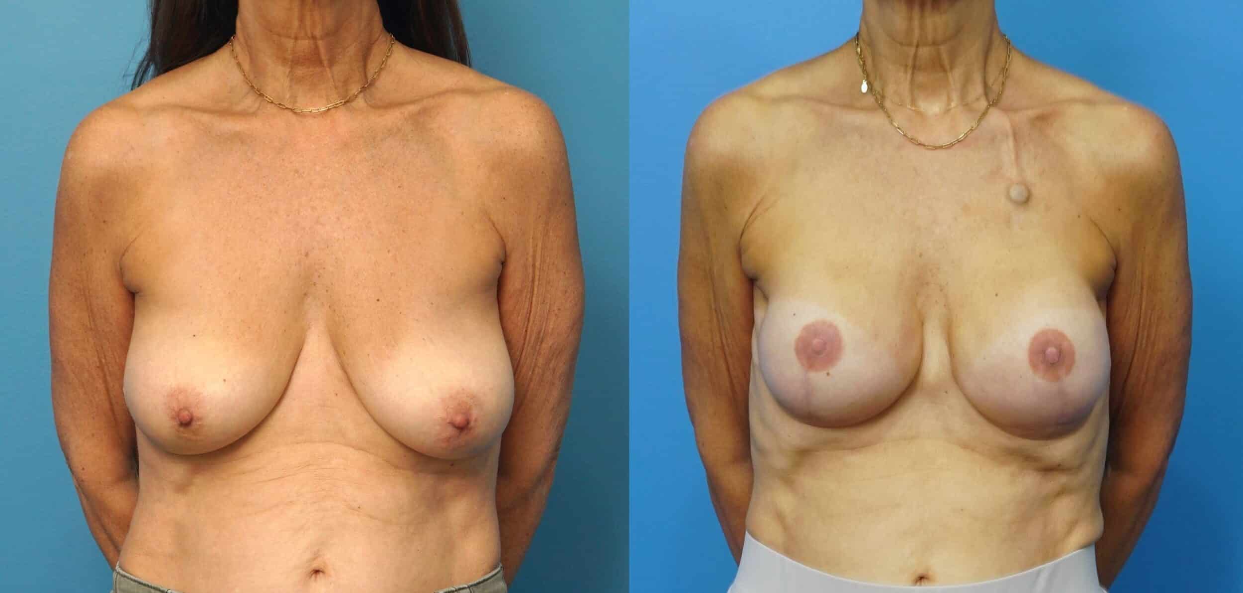 Before and After Image: Breast Reconstruction with Tissue Expanders